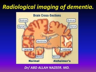 Radiological imaging of dementia. 
Dr/ ABD ALLAH NAZEER. MD. 
 
