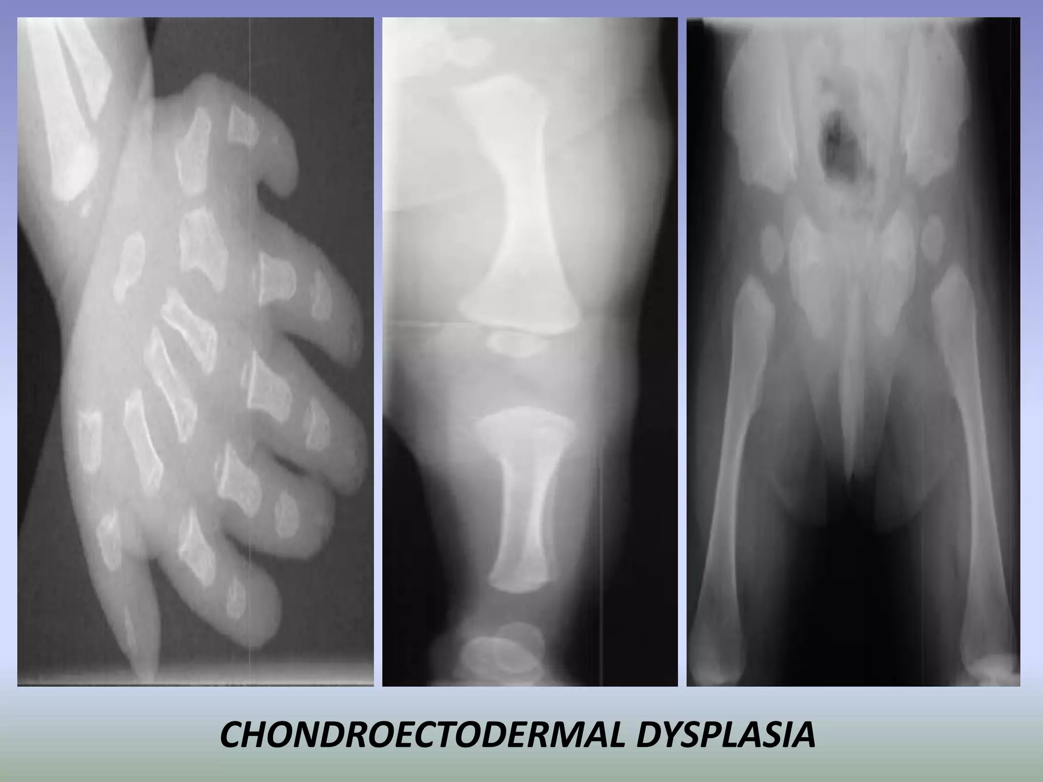 CHONDROECTODERMAL DYSPLASIA 
 