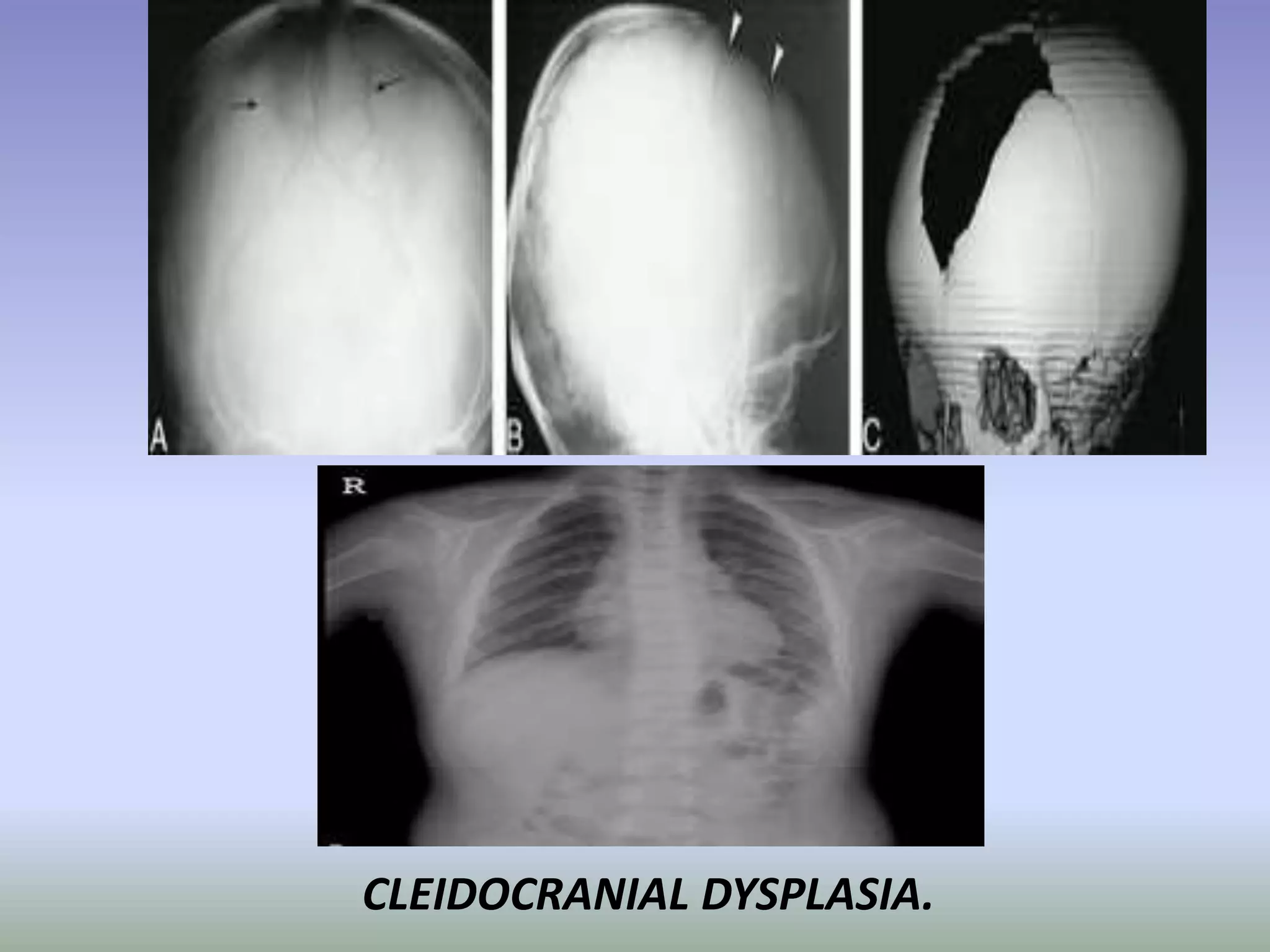 CLEIDOCRANIAL DYSPLASIA. 
 