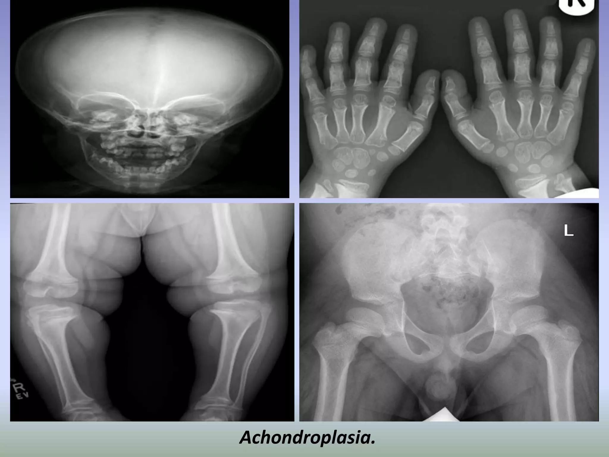 Achondroplasia. 
 