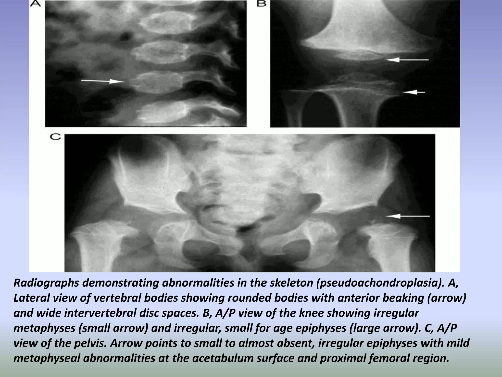 Radiographs demonstrating abnormalities in the skeleton (pseudoachondroplasia). A, 
Lateral view of vertebral bodies showing rounded bodies with anterior beaking (arrow) 
and wide intervertebral disc spaces. B, A/P view of the knee showing irregular 
metaphyses (small arrow) and irregular, small for age epiphyses (large arrow). C, A/P 
view of the pelvis. Arrow points to small to almost absent, irregular epiphyses with mild 
metaphyseal abnormalities at the acetabulum surface and proximal femoral region. 
 