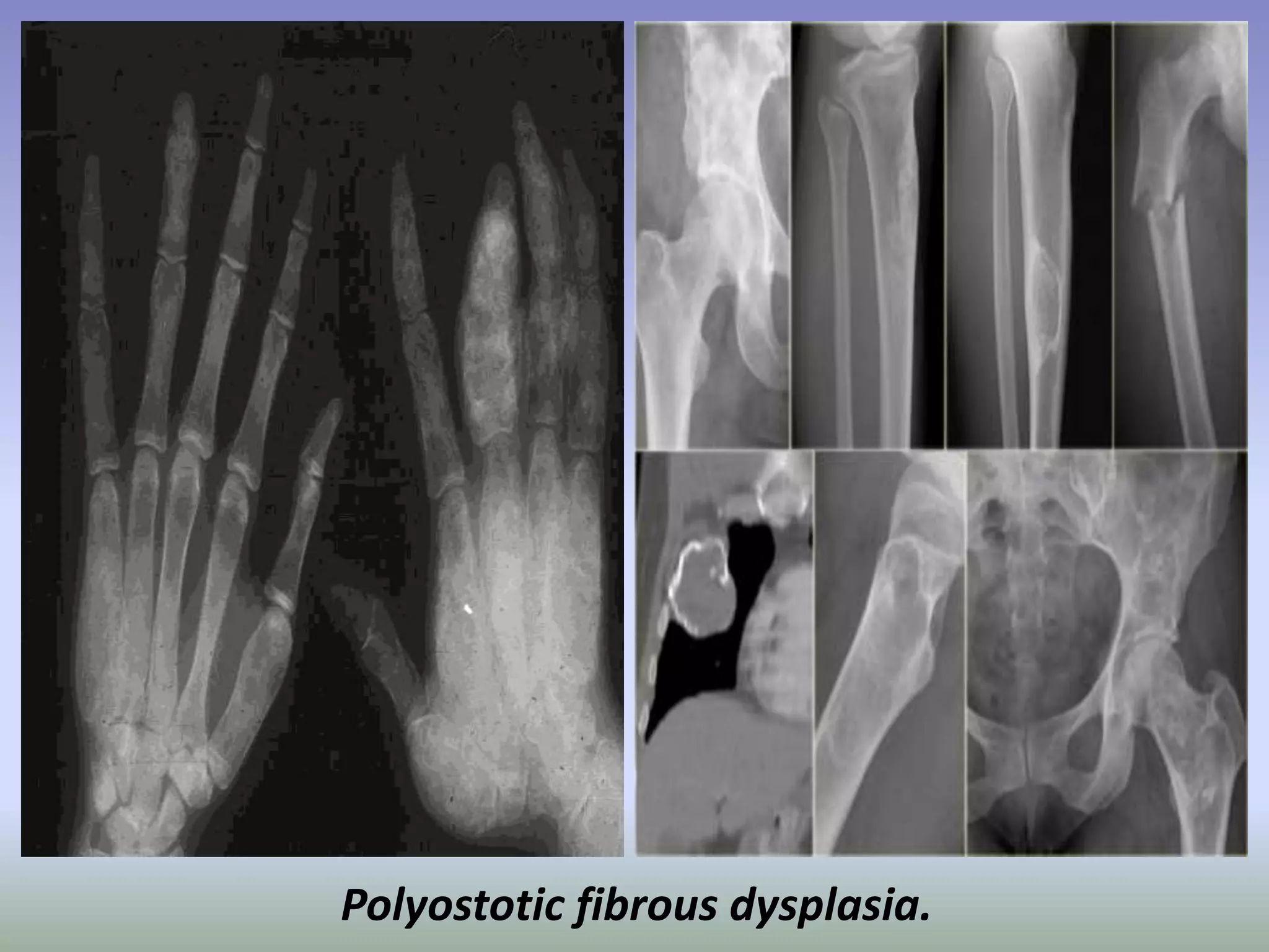 Polyostotic fibrous dysplasia. 
 