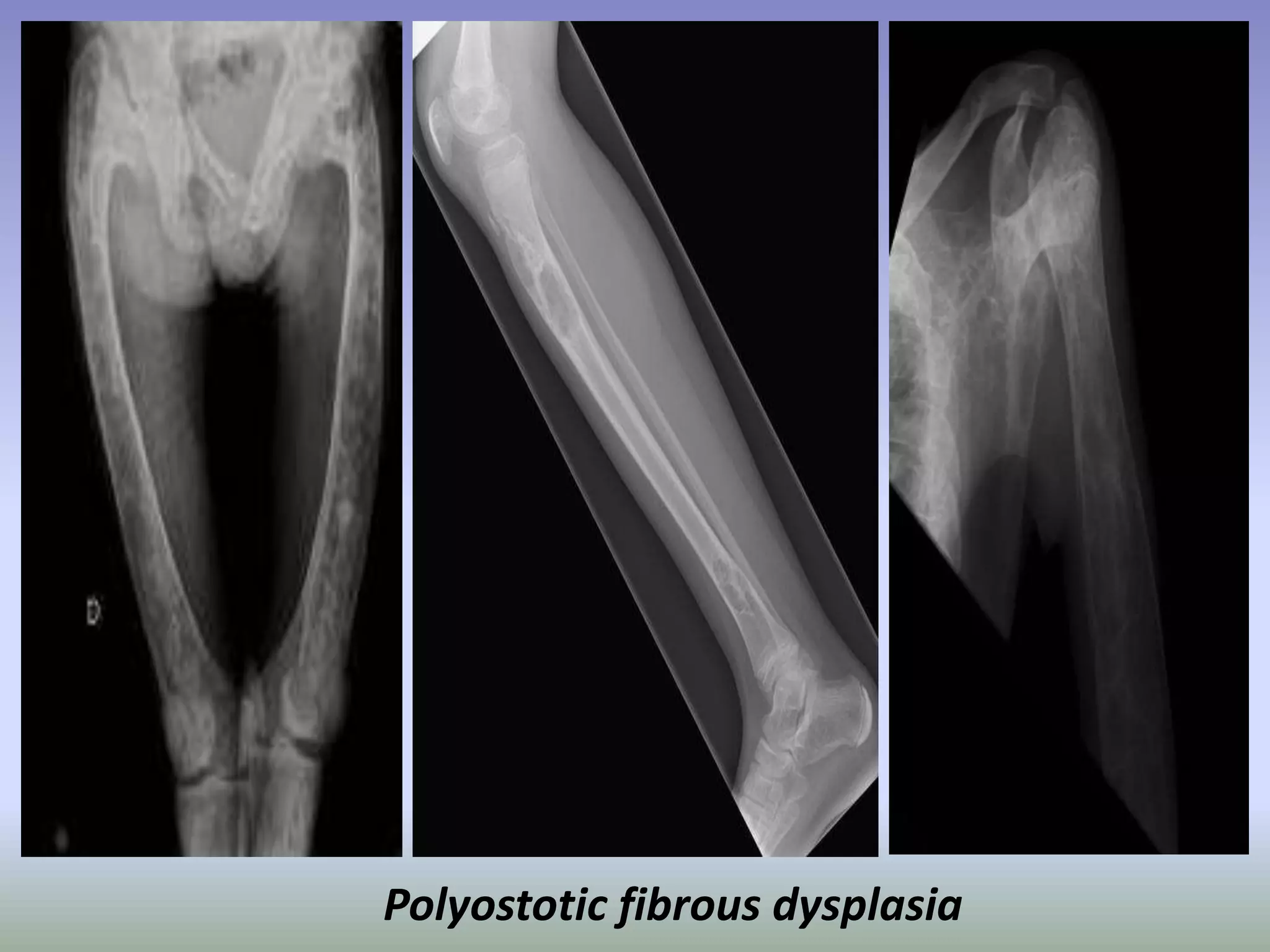 Polyostotic fibrous dysplasia 
 