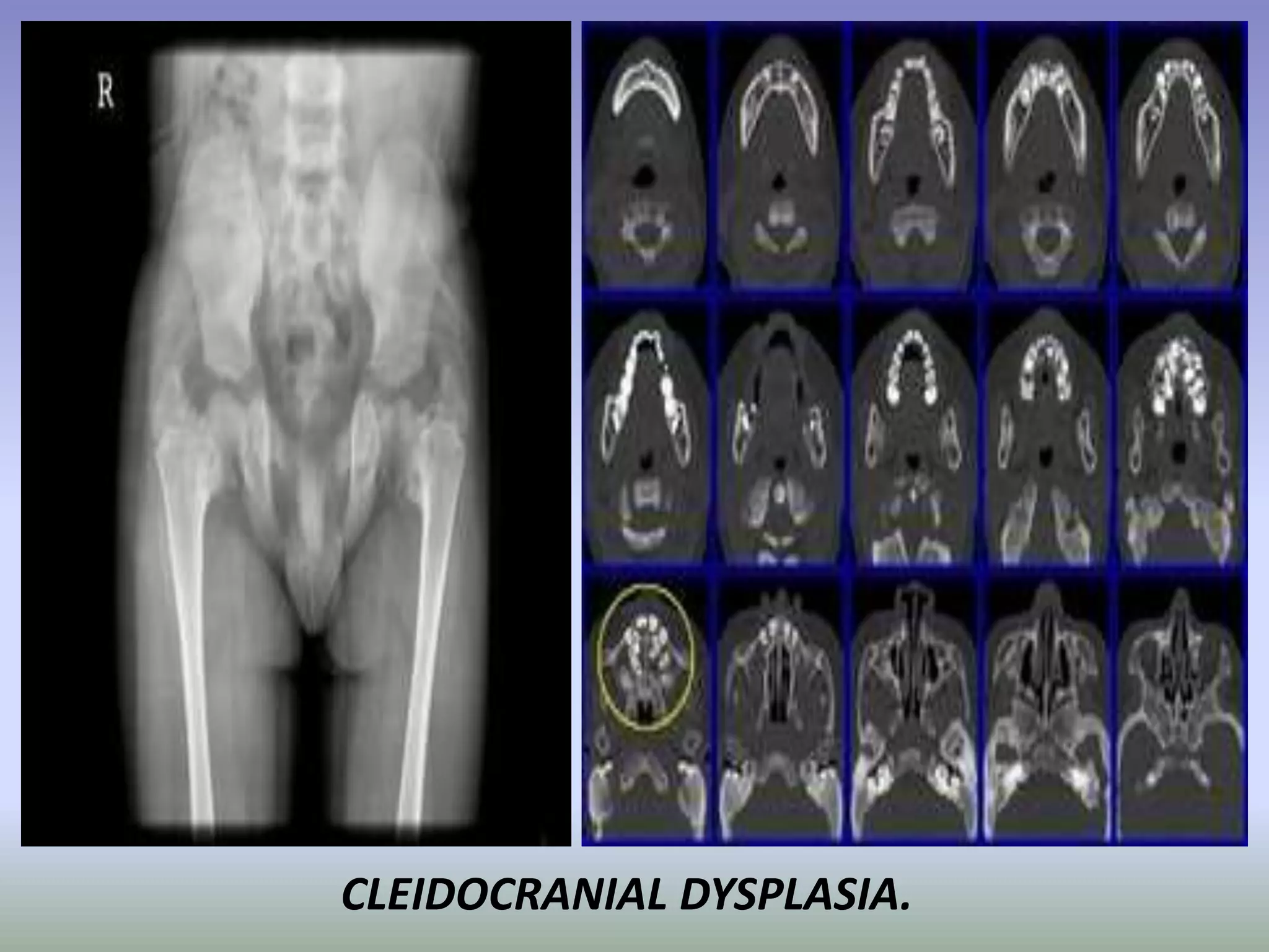 CLEIDOCRANIAL DYSPLASIA. 
 