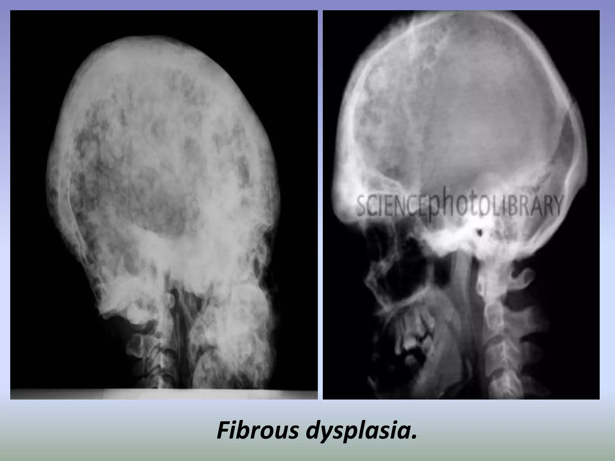 Fibrous dysplasia. 
 