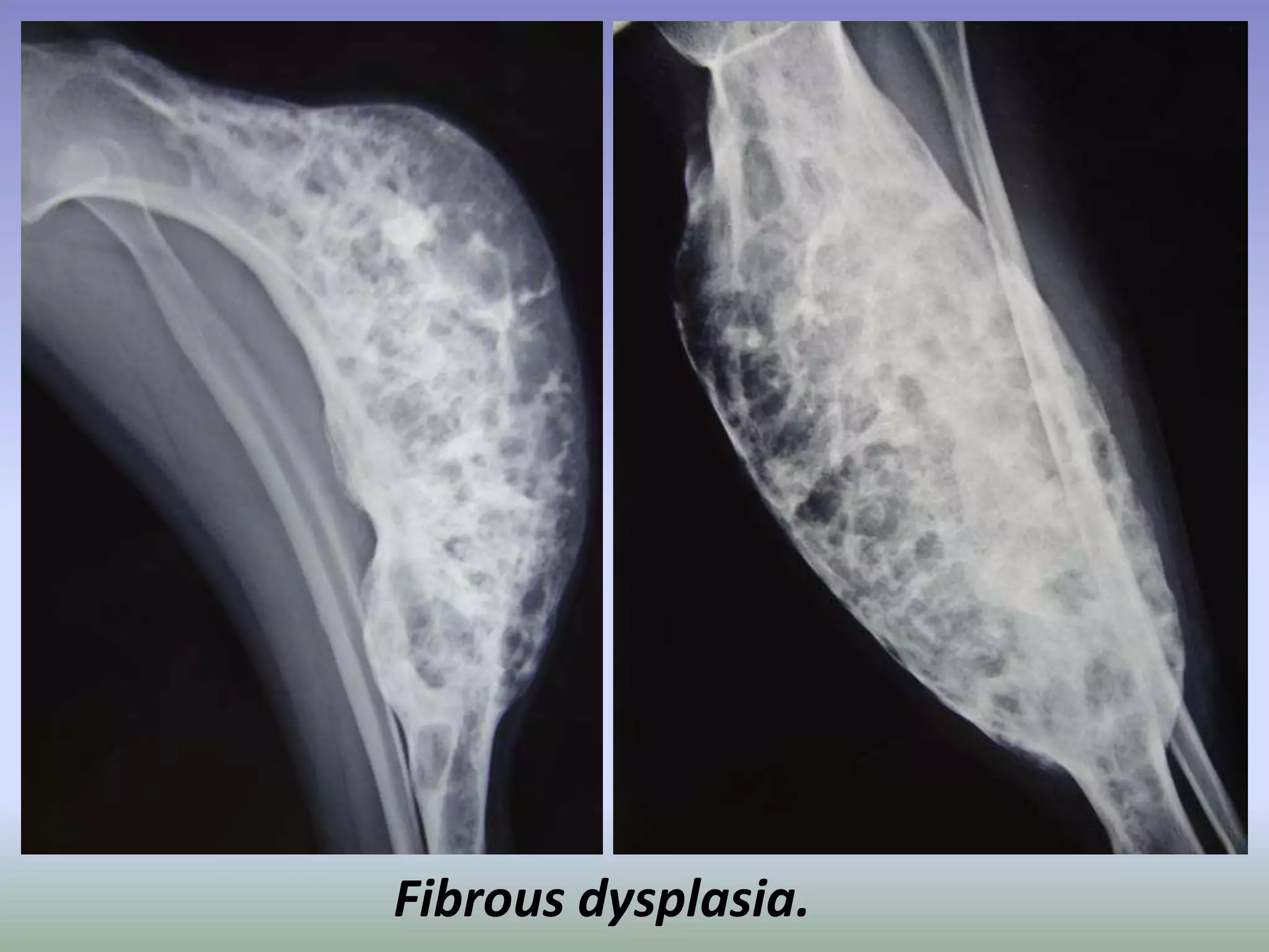 Fibrous dysplasia. 
 