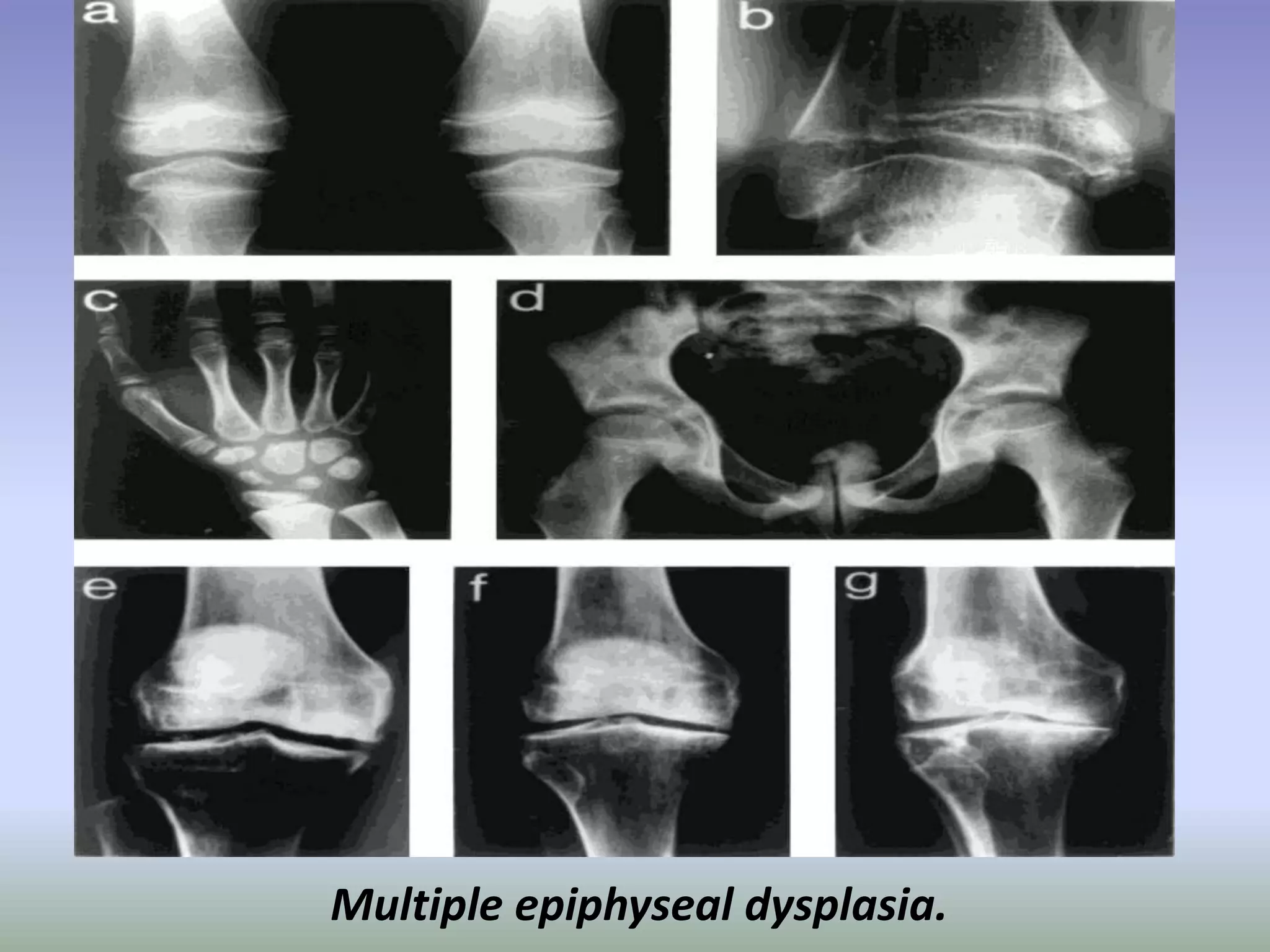 Multiple epiphyseal dysplasia. 
 