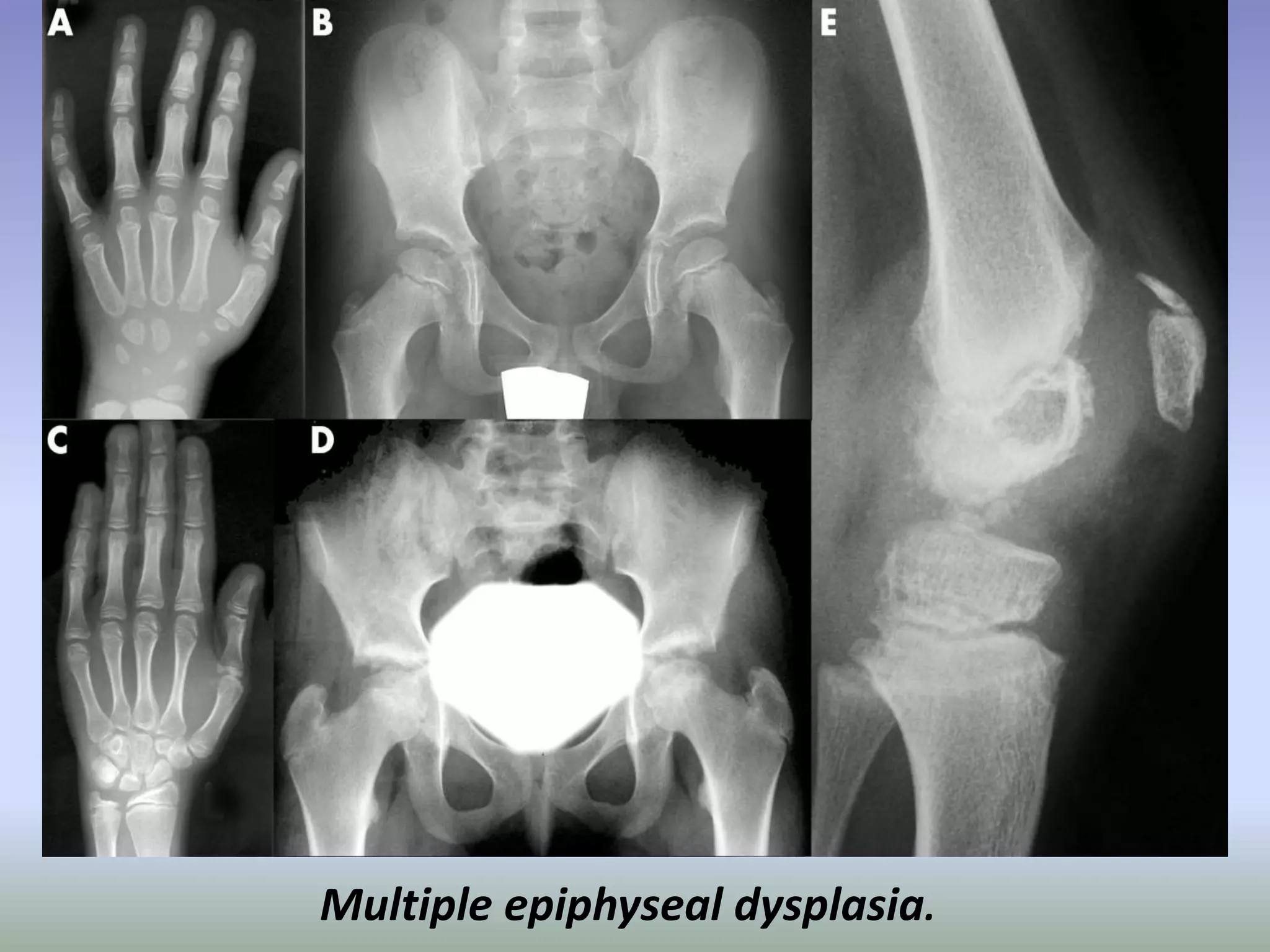 Multiple epiphyseal dysplasia. 
 