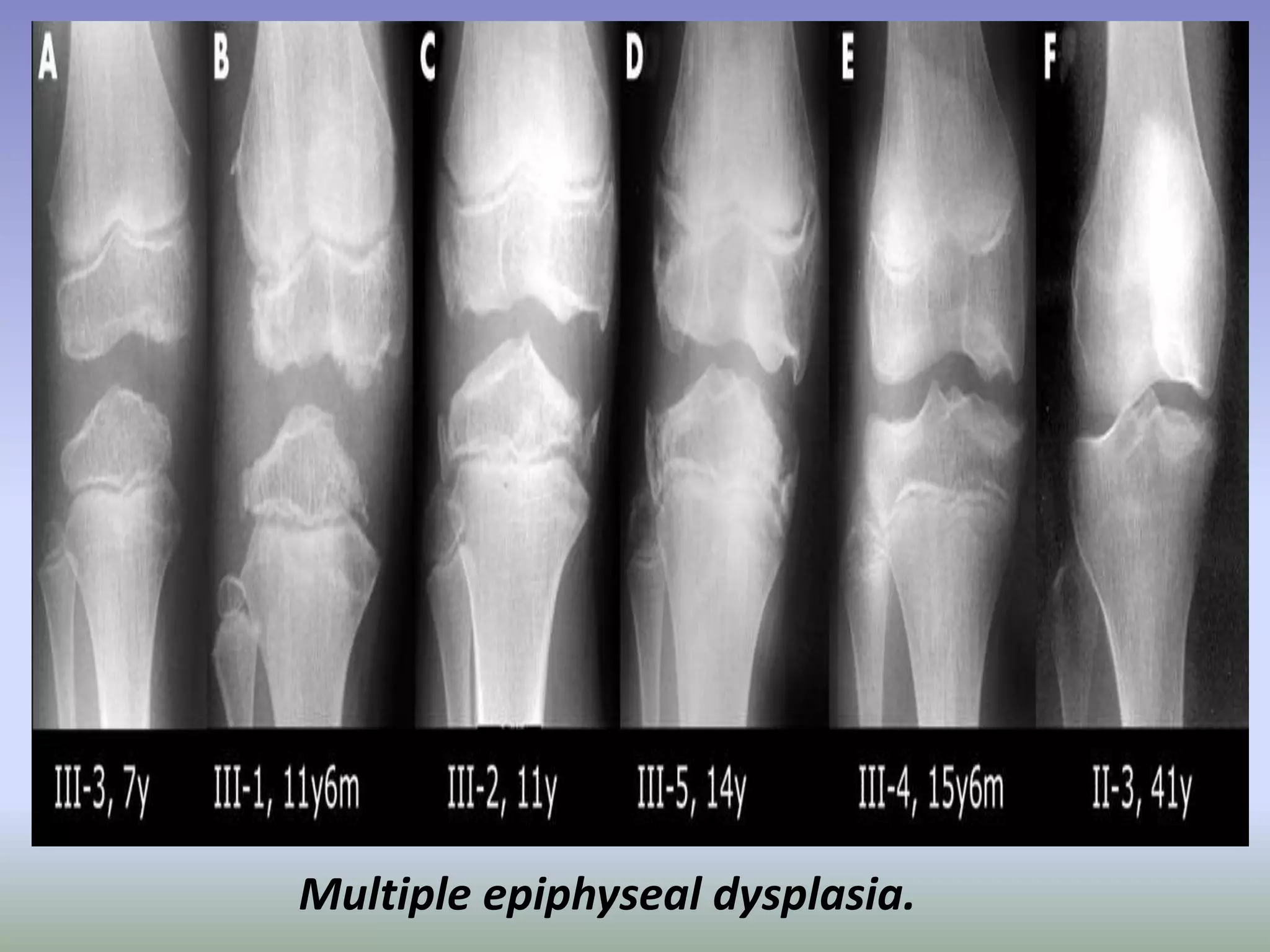 Multiple epiphyseal dysplasia. 
 