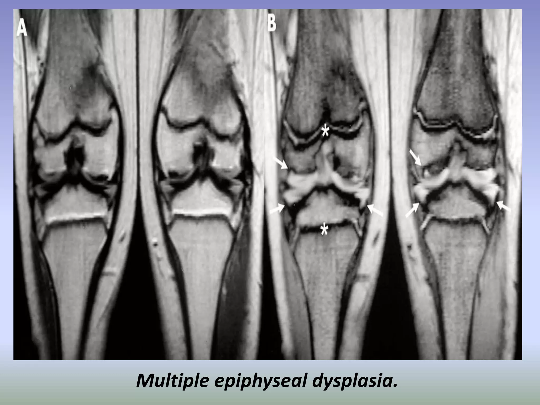 Multiple epiphyseal dysplasia. 
 