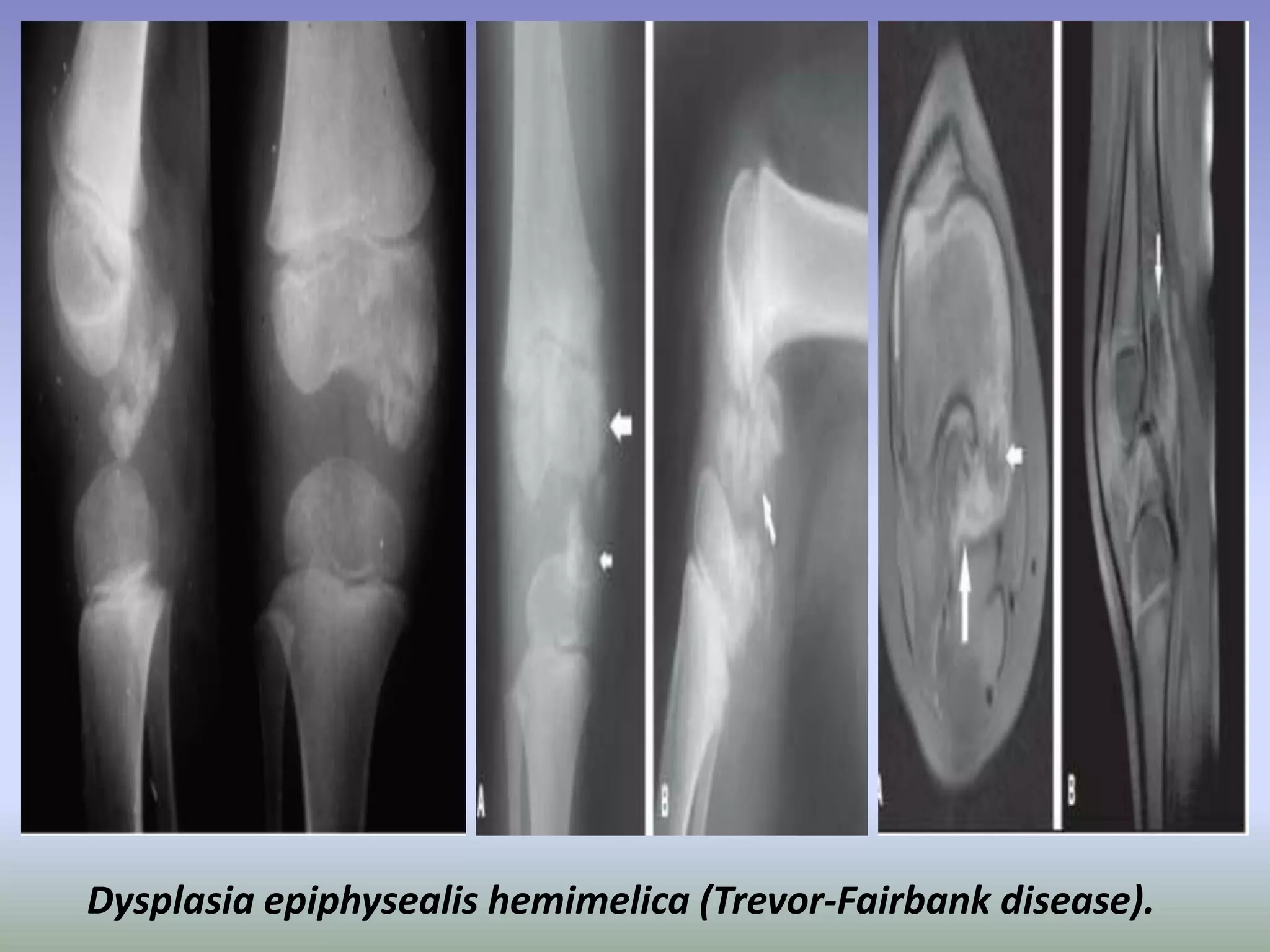 Dysplasia epiphysealis hemimelica (Trevor-Fairbank disease). 
 