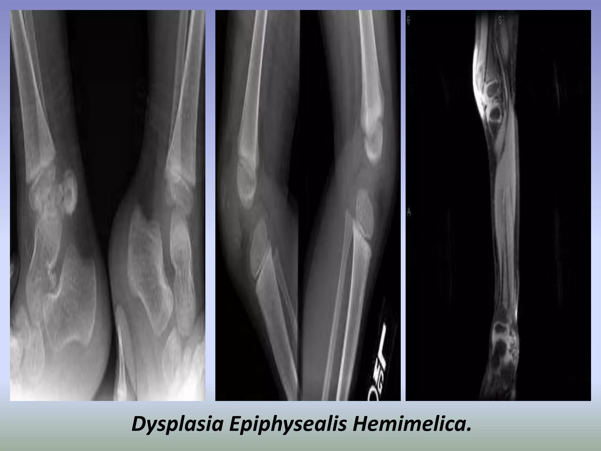 Dysplasia Epiphysealis Hemimelica. 
 