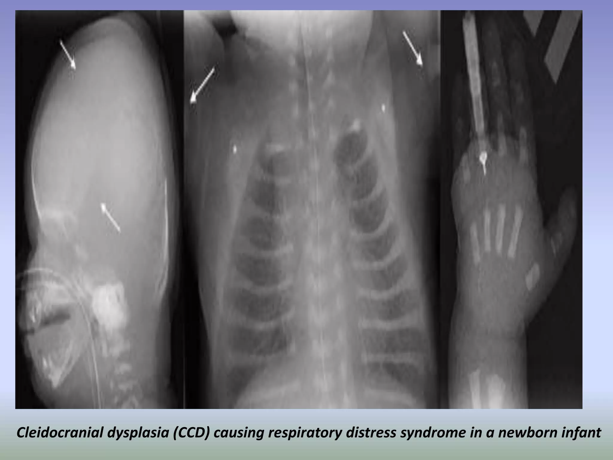 Cleidocranial dysplasia (CCD) causing respiratory distress syndrome in a newborn infant 
 