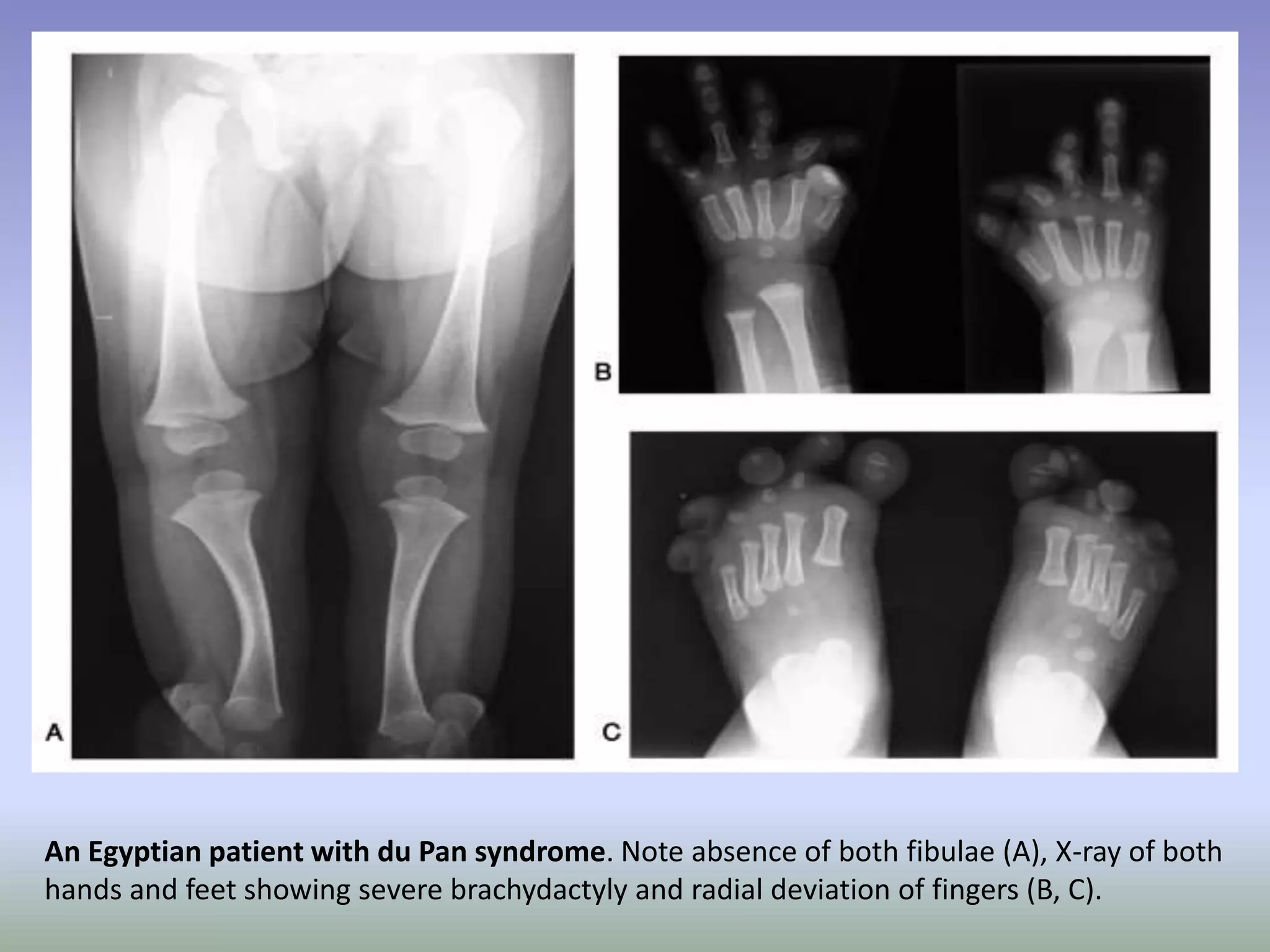 An Egyptian patient with du Pan syndrome. Note absence of both fibulae (A), X-ray of both 
hands and feet showing severe brachydactyly and radial deviation of fingers (B, C). 
 