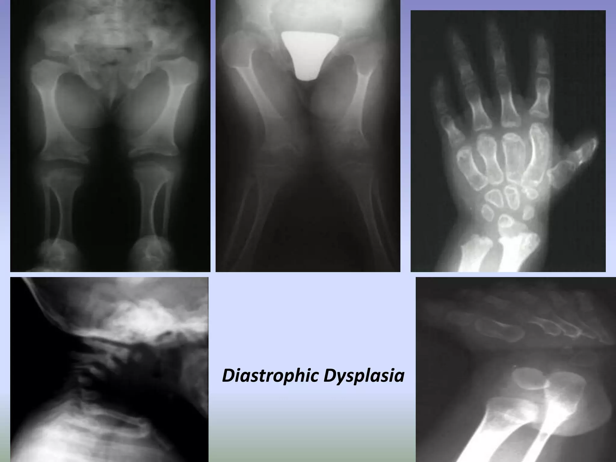 Diastrophic Dysplasia 
 