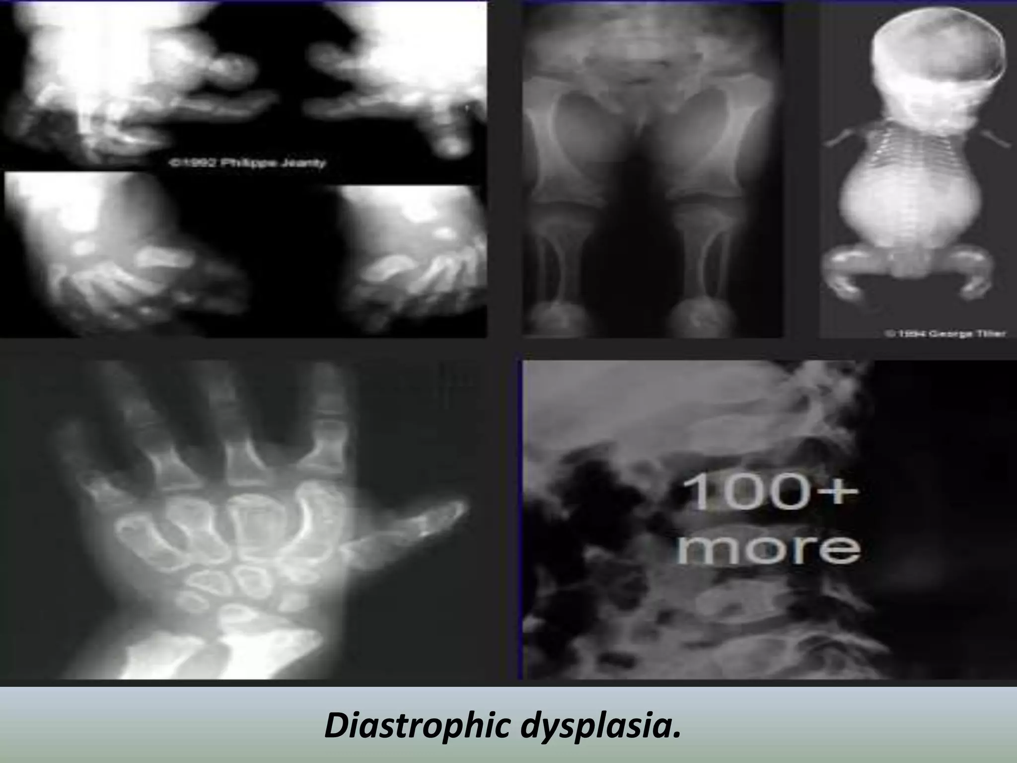 Diastrophic dysplasia. 
 