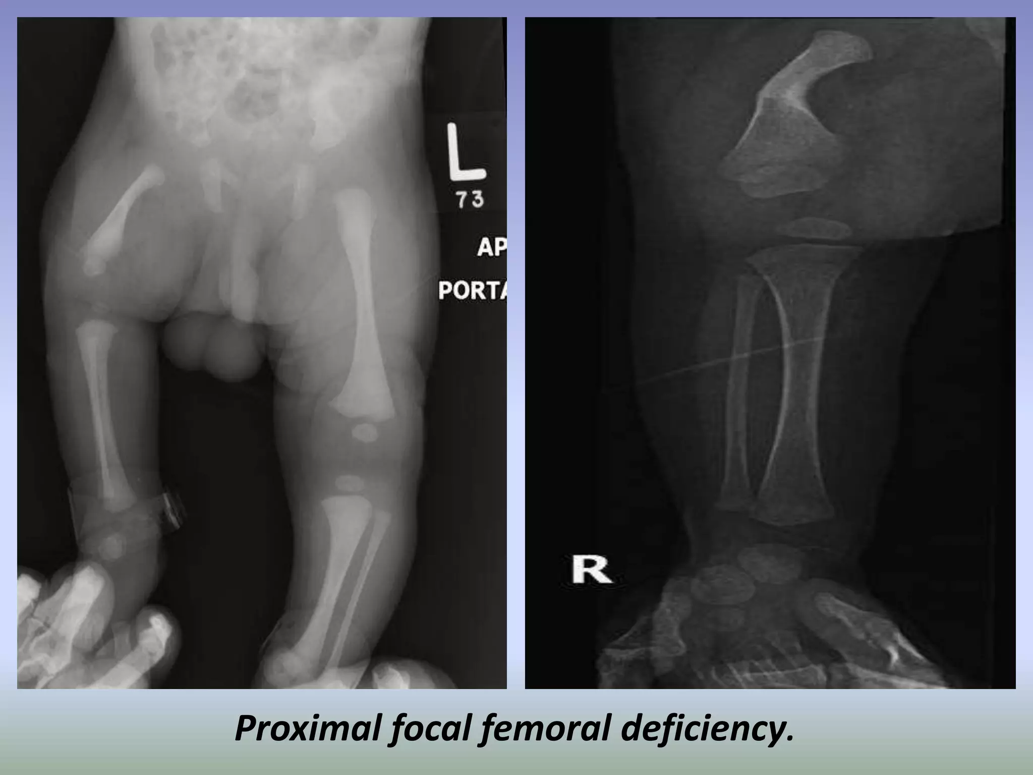 Proximal focal femoral deficiency. 
 