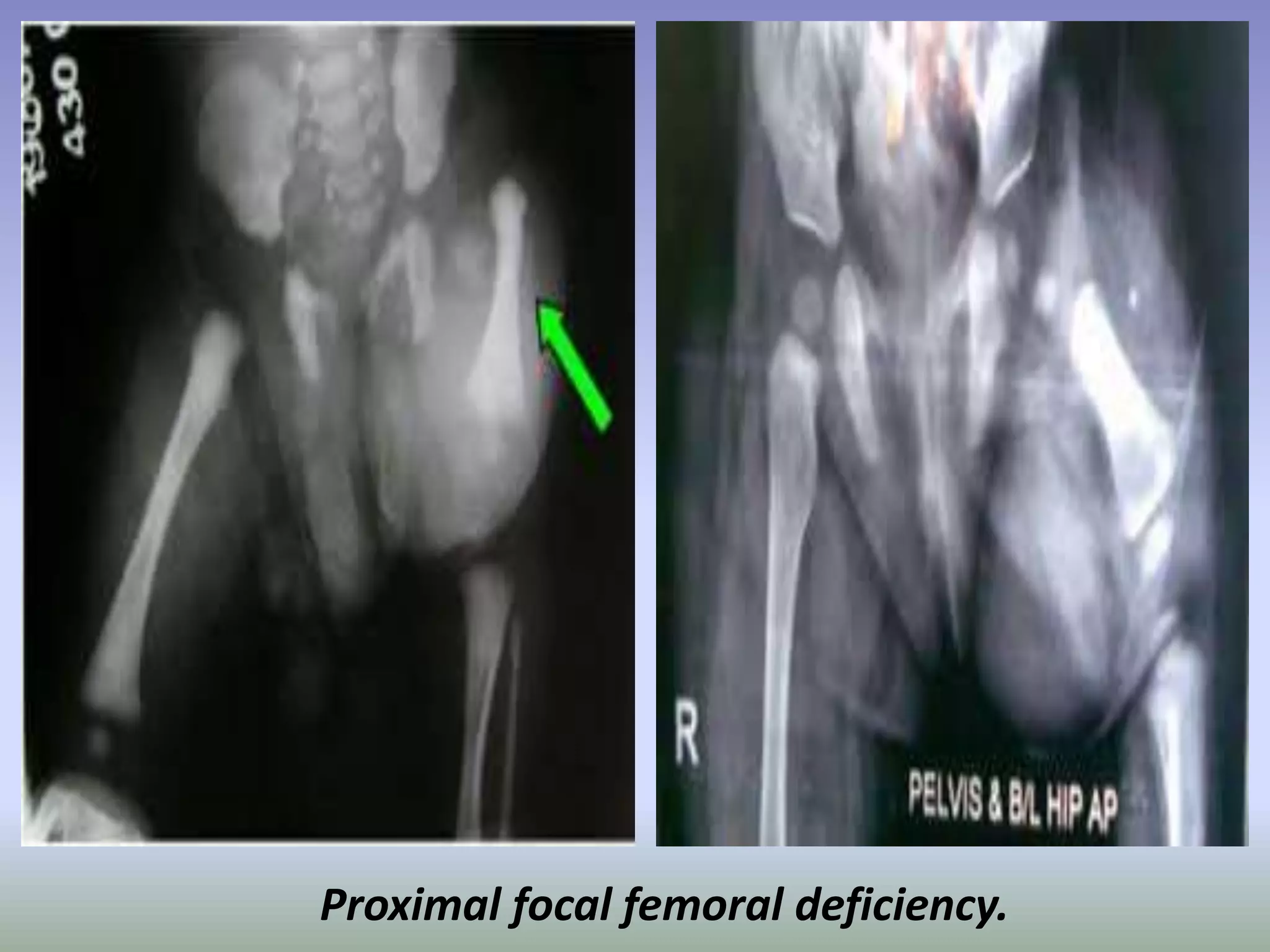 Proximal focal femoral deficiency. 
 