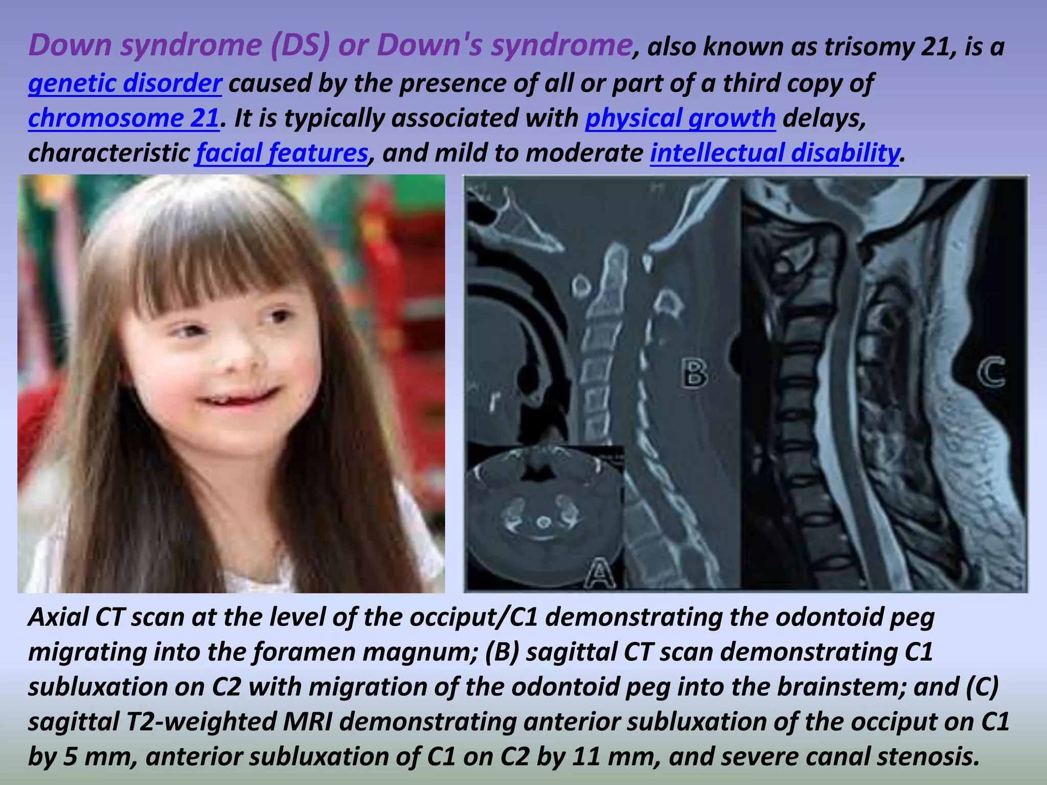 Down syndrome (DS) or Down's syndrome, also known as trisomy 21, is a 
genetic disorder caused by the presence of all or part of a third copy of 
chromosome 21. It is typically associated with physical growth delays, 
characteristic facial features, and mild to moderate intellectual disability. 
Axial CT scan at the level of the occiput/C1 demonstrating the odontoid peg 
migrating into the foramen magnum; (B) sagittal CT scan demonstrating C1 
subluxation on C2 with migration of the odontoid peg into the brainstem; and (C) 
sagittal T2-weighted MRI demonstrating anterior subluxation of the occiput on C1 
by 5 mm, anterior subluxation of C1 on C2 by 11 mm, and severe canal stenosis. 
 