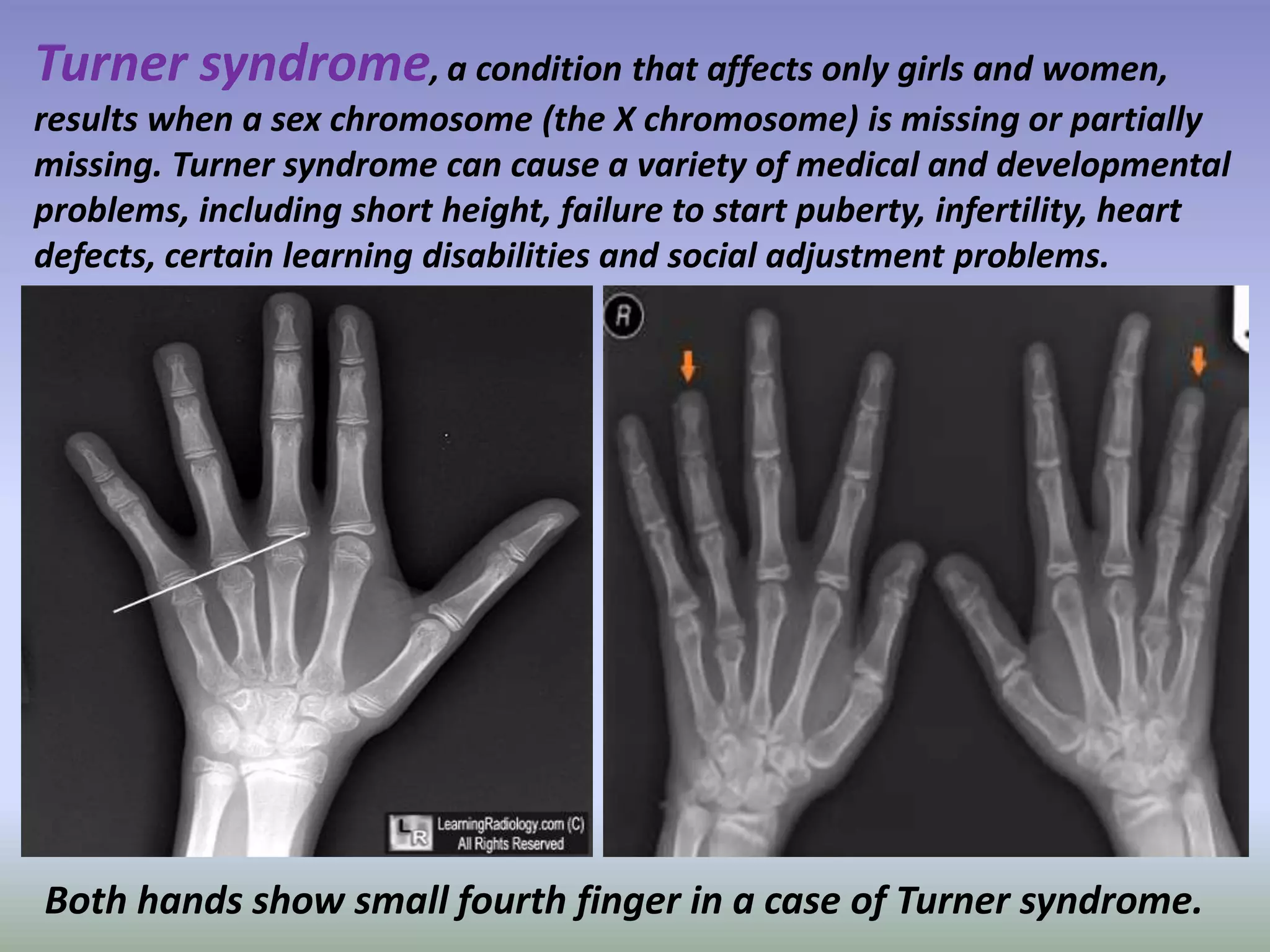 Turner syndrome, a condition that affects only girls and women, 
results when a sex chromosome (the X chromosome) is missing or partially 
missing. Turner syndrome can cause a variety of medical and developmental 
problems, including short height, failure to start puberty, infertility, heart 
defects, certain learning disabilities and social adjustment problems. 
Both hands show small fourth finger in a case of Turner syndrome. 
 