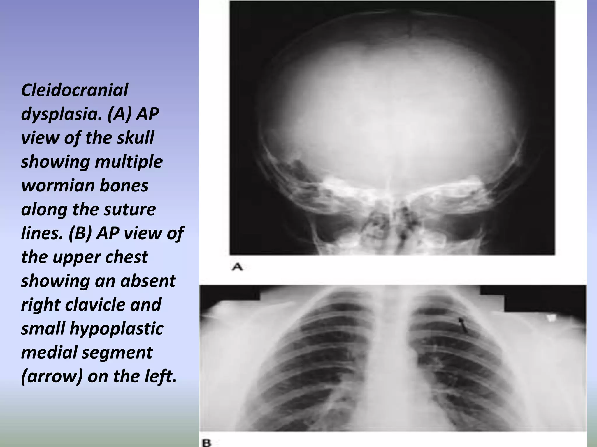 Cleidocranial 
dysplasia. (A) AP 
view of the skull 
showing multiple 
wormian bones 
along the suture 
lines. (B) AP view of 
the upper chest 
showing an absent 
right clavicle and 
small hypoplastic 
medial segment 
(arrow) on the left. 
 