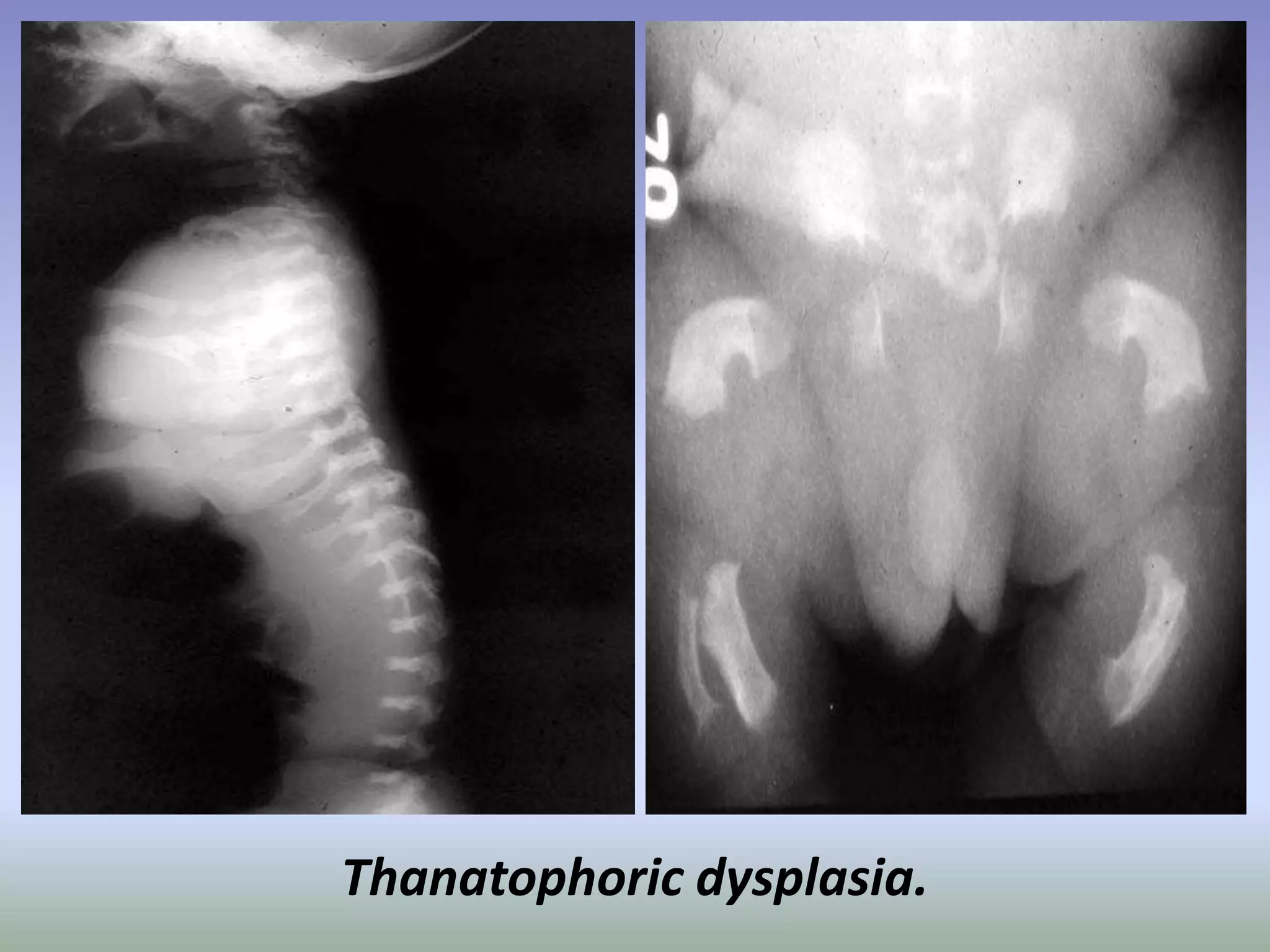 Thanatophoric dysplasia. 
 