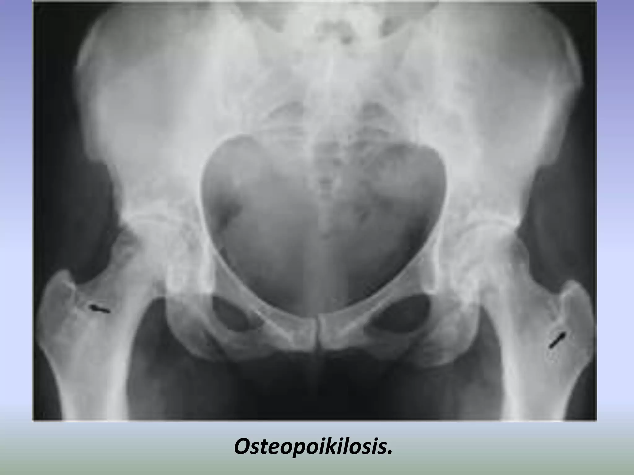 Osteopoikilosis. 
 