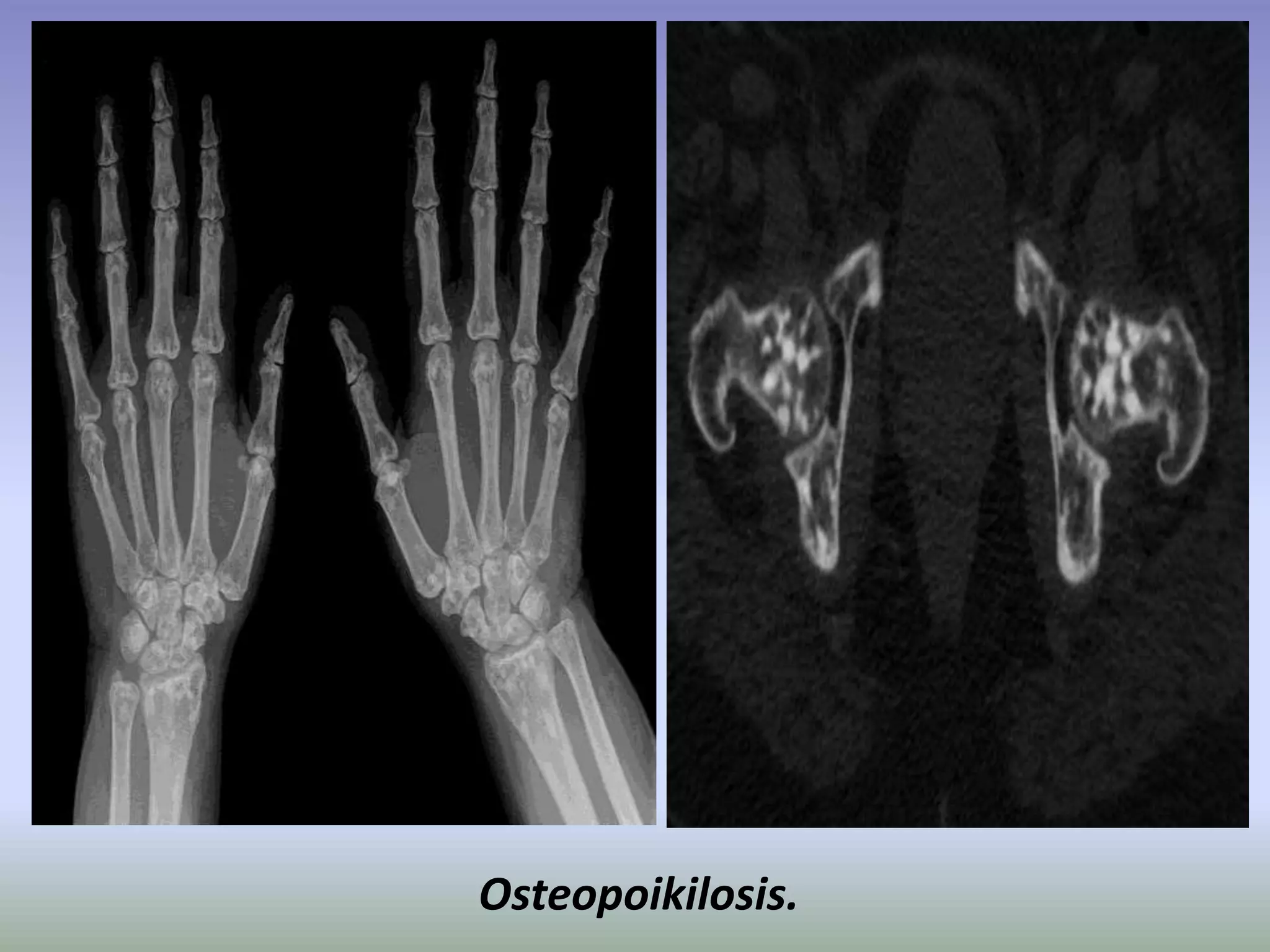 Osteopoikilosis. 
 