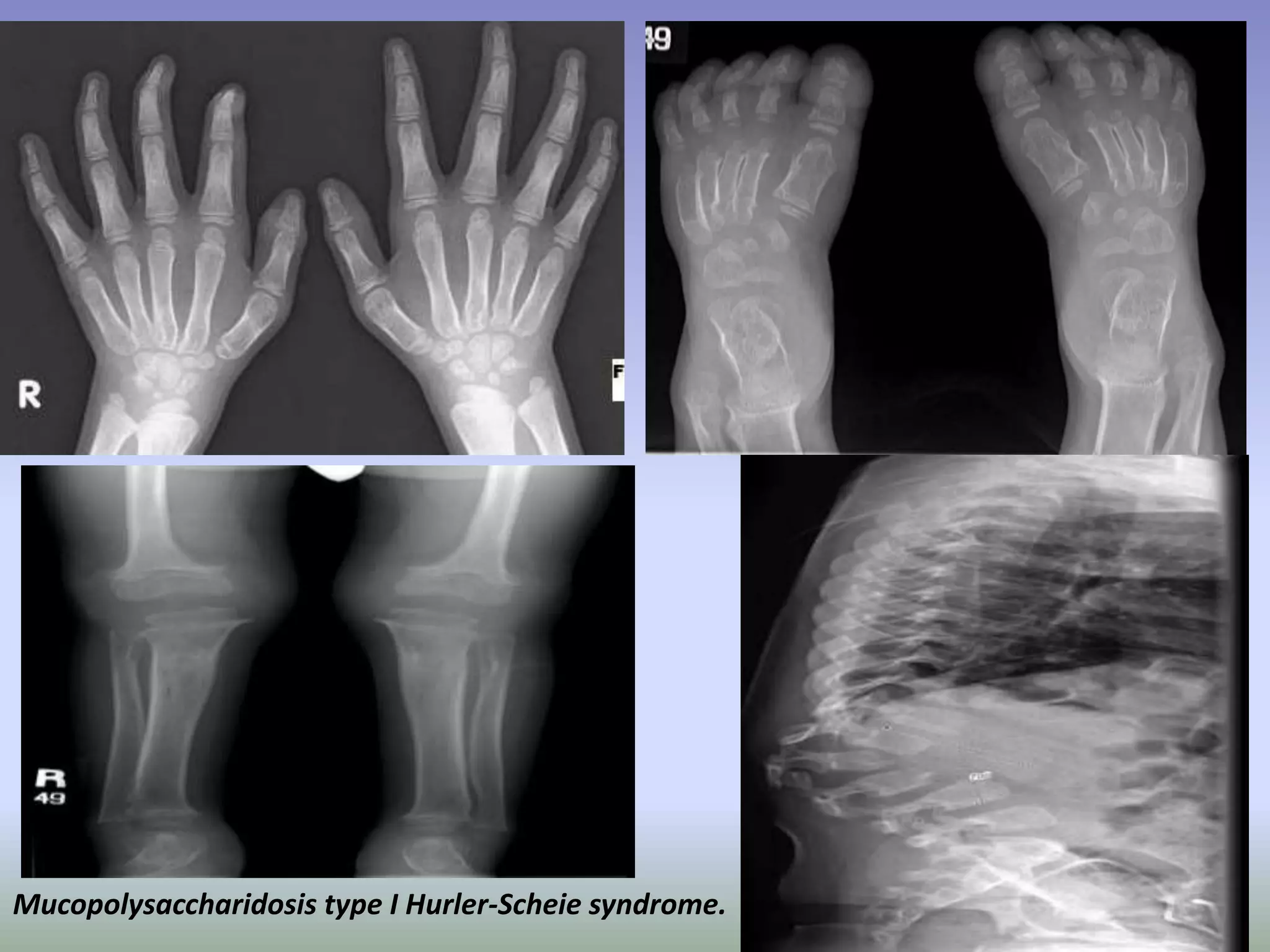 Mucopolysaccharidosis type I Hurler-Scheie syndrome. 
 