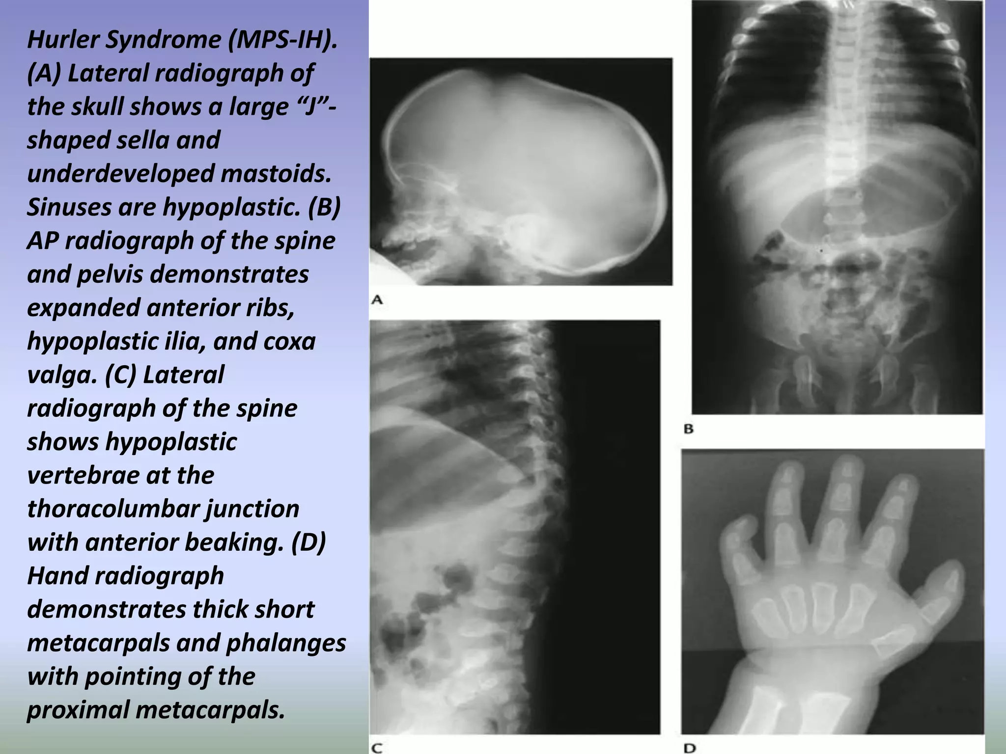 Hurler Syndrome (MPS-IH). 
(A) Lateral radiograph of 
the skull shows a large “J”- 
shaped sella and 
underdeveloped mastoids. 
Sinuses are hypoplastic. (B) 
AP radiograph of the spine 
and pelvis demonstrates 
expanded anterior ribs, 
hypoplastic ilia, and coxa 
valga. (C) Lateral 
radiograph of the spine 
shows hypoplastic 
vertebrae at the 
thoracolumbar junction 
with anterior beaking. (D) 
Hand radiograph 
demonstrates thick short 
metacarpals and phalanges 
with pointing of the 
proximal metacarpals. 
 