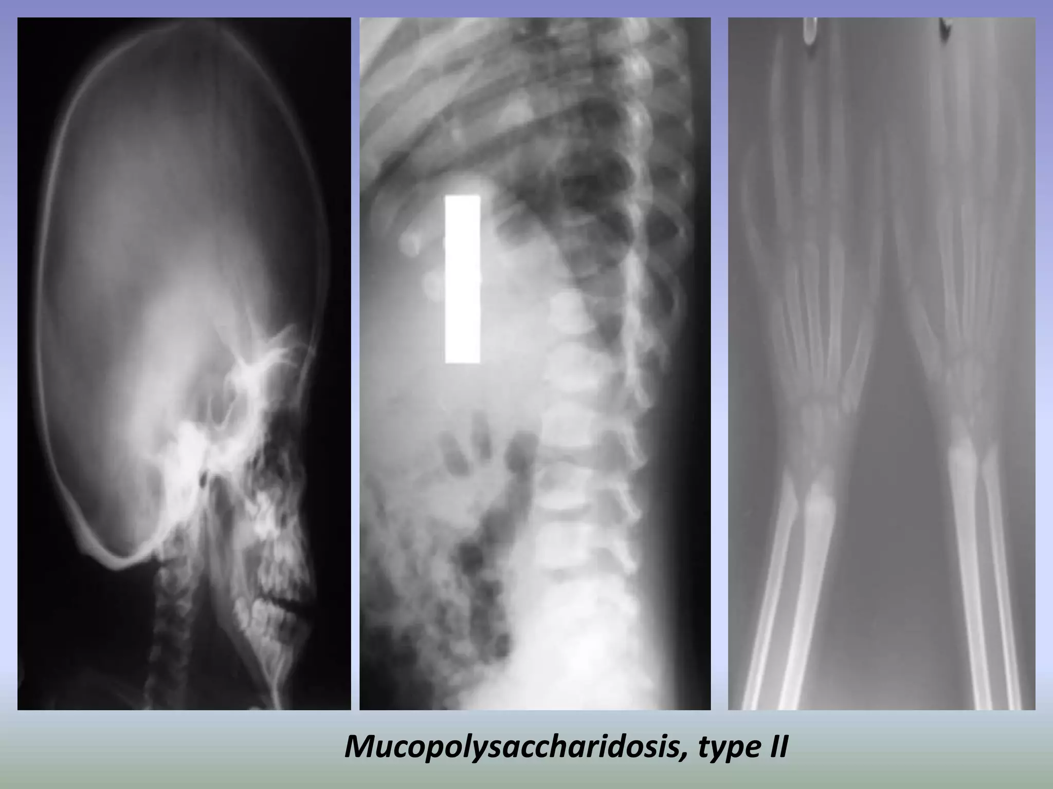 Mucopolysaccharidosis, type II 
 