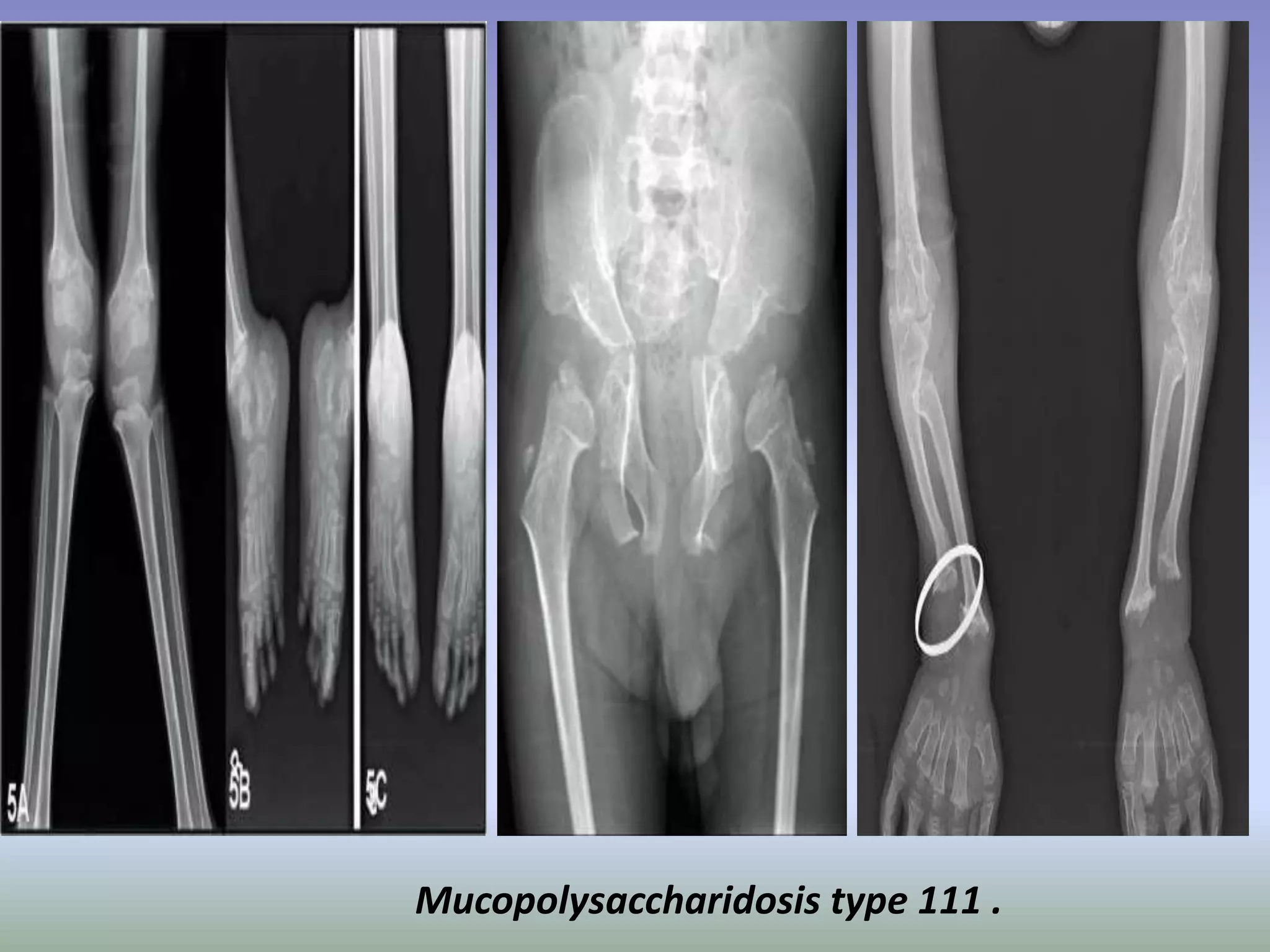 Mucopolysaccharidosis type 111 . 
 