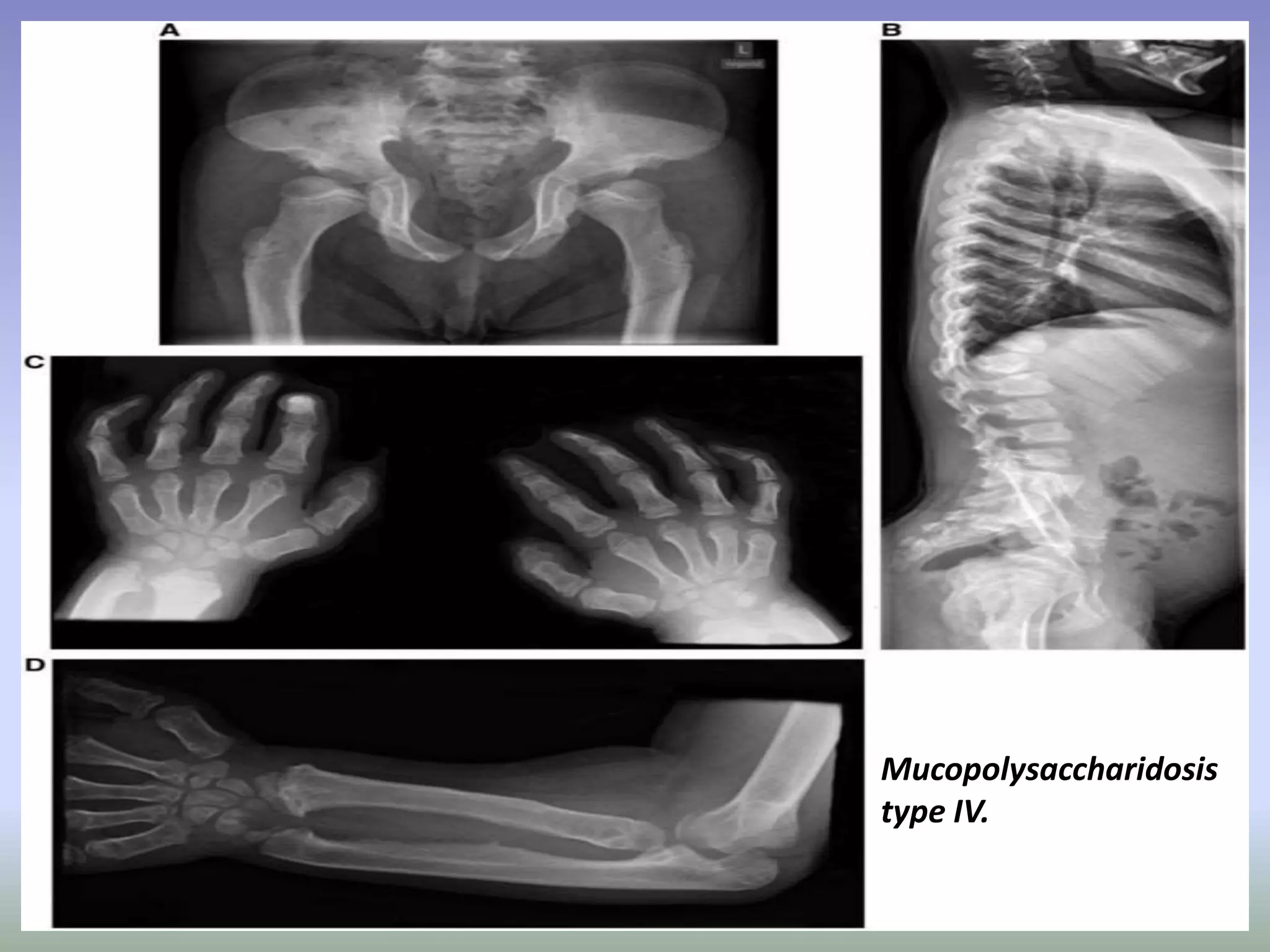 Mucopolysaccharidosis 
type IV. 
 