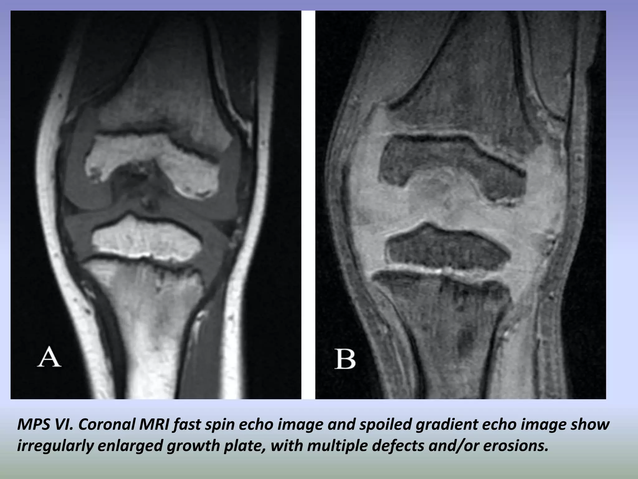 MPS VI. Coronal MRI fast spin echo image and spoiled gradient echo image show 
irregularly enlarged growth plate, with multiple defects and/or erosions. 
 