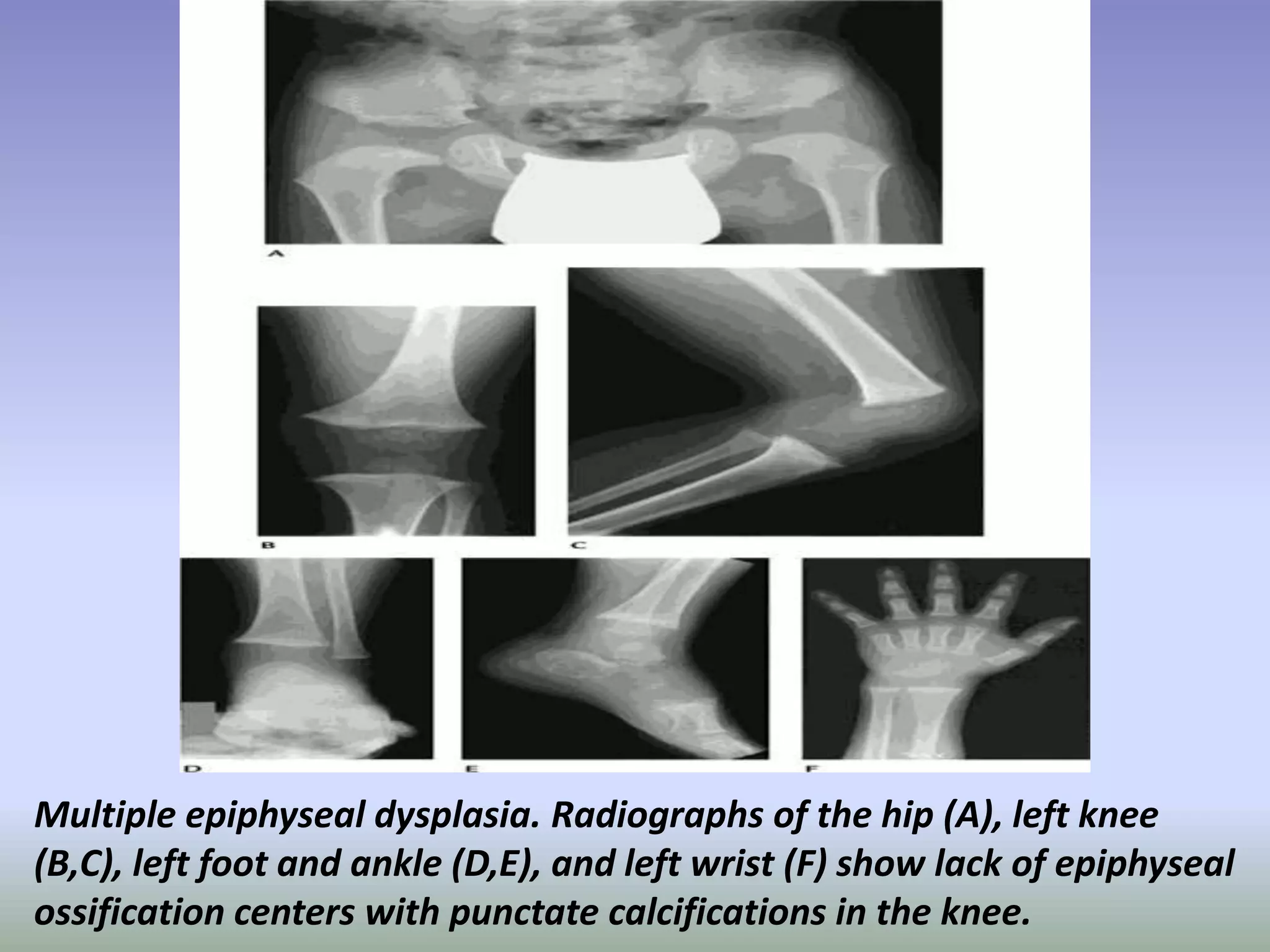 Multiple epiphyseal dysplasia. Radiographs of the hip (A), left knee 
(B,C), left foot and ankle (D,E), and left wrist (F) show lack of epiphyseal 
ossification centers with punctate calcifications in the knee. 
 