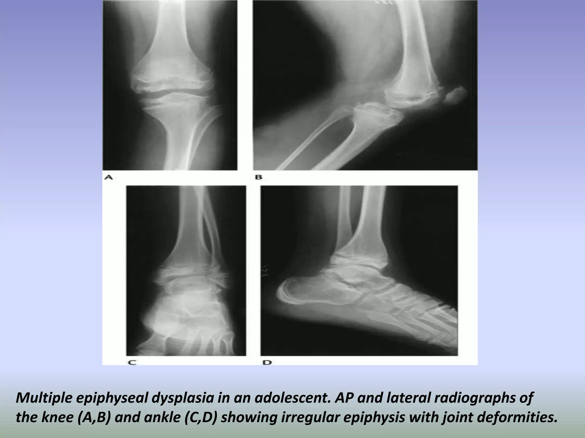 Multiple epiphyseal dysplasia in an adolescent. AP and lateral radiographs of 
the knee (A,B) and ankle (C,D) showing irregular epiphysis with joint deformities. 
 
