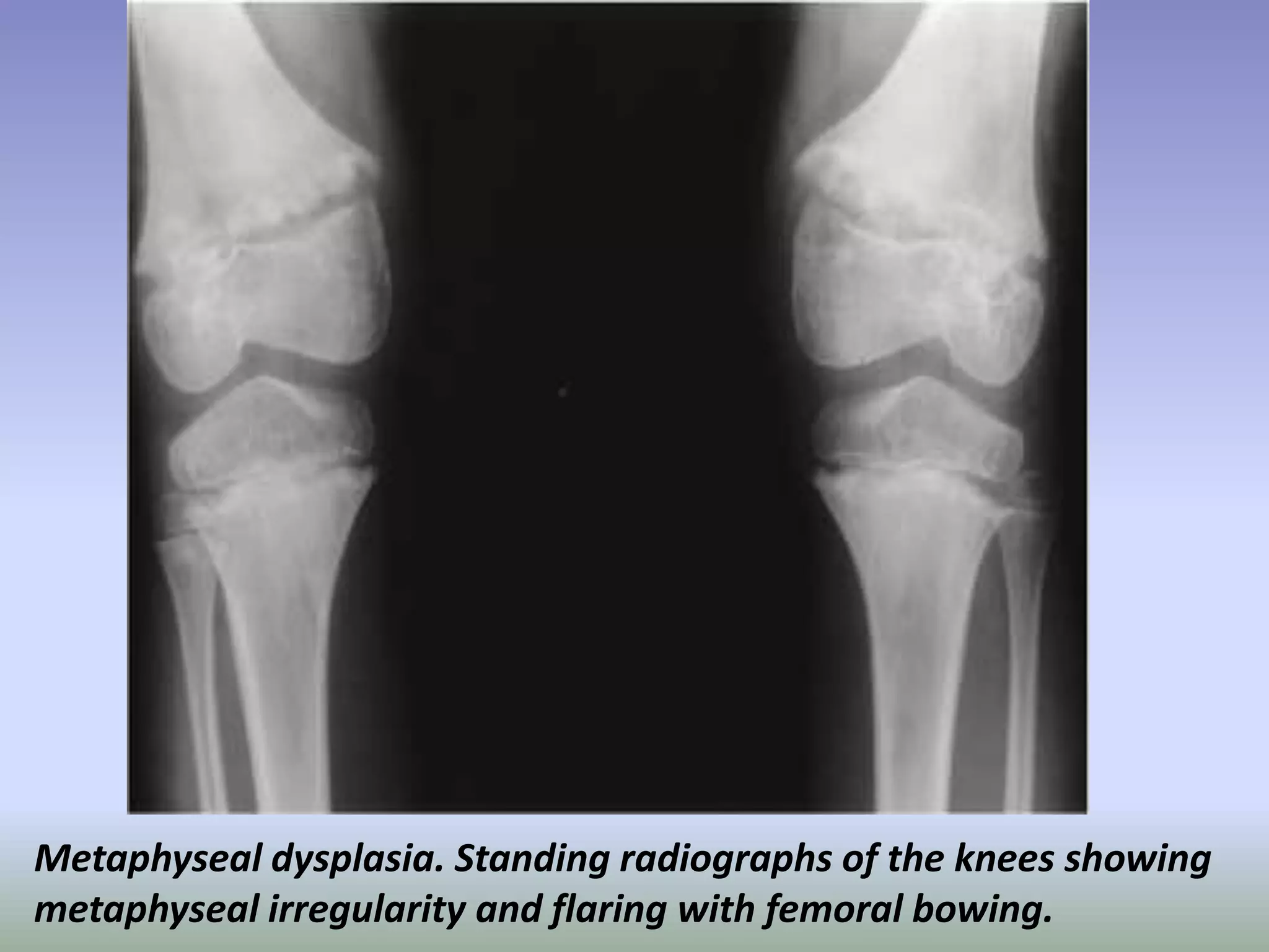 Metaphyseal dysplasia. Standing radiographs of the knees showing 
metaphyseal irregularity and flaring with femoral bowing. 
 