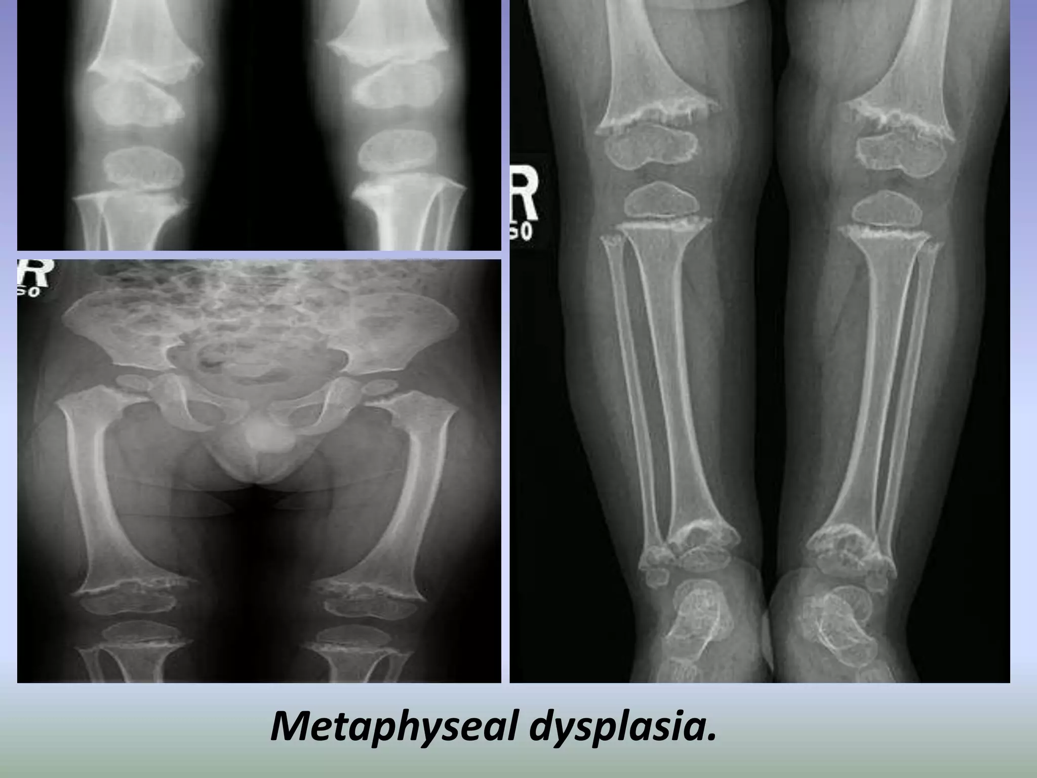 Metaphyseal dysplasia. 
 