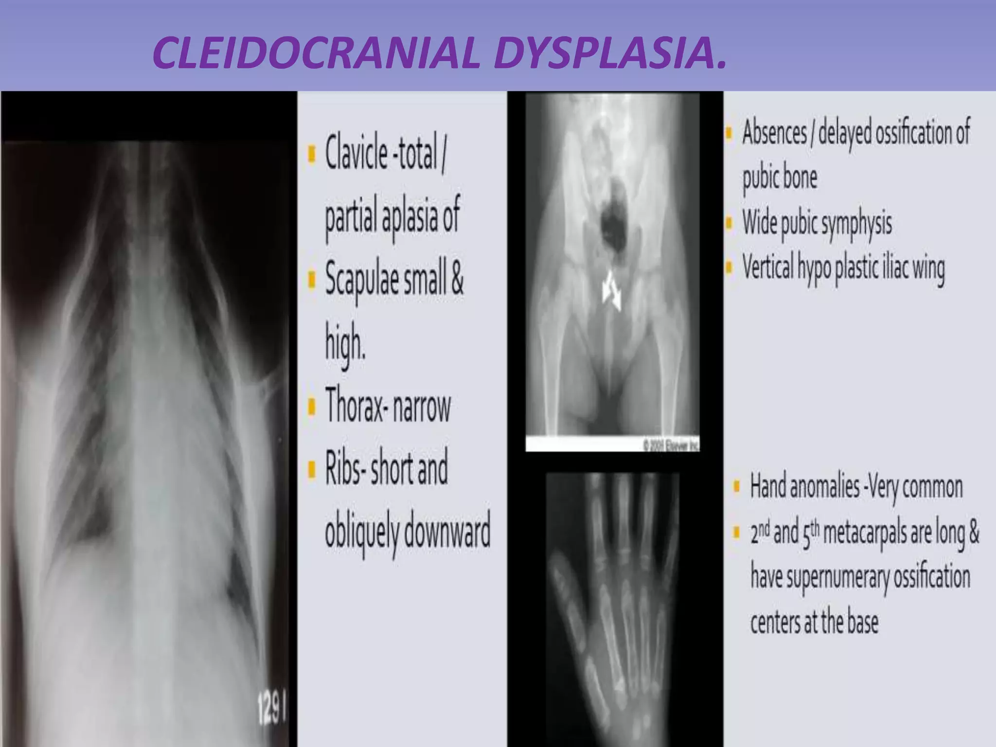 CLEIDOCRANIAL DYSPLASIA. 
 