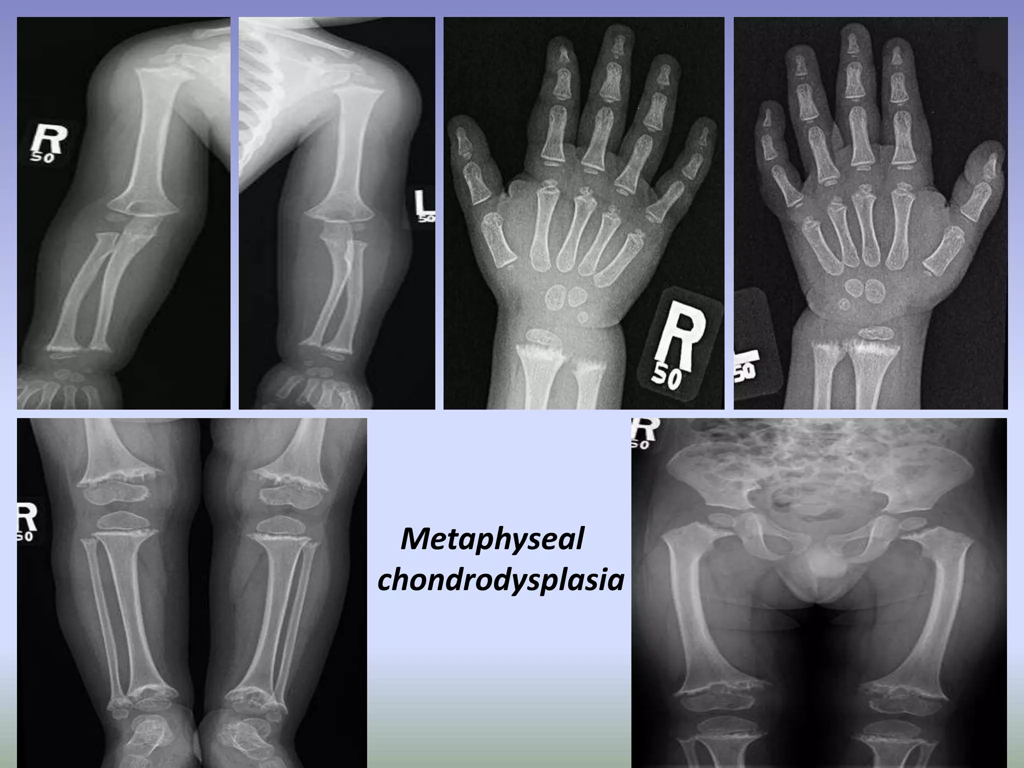 Metaphyseal 
chondrodysplasia 
 