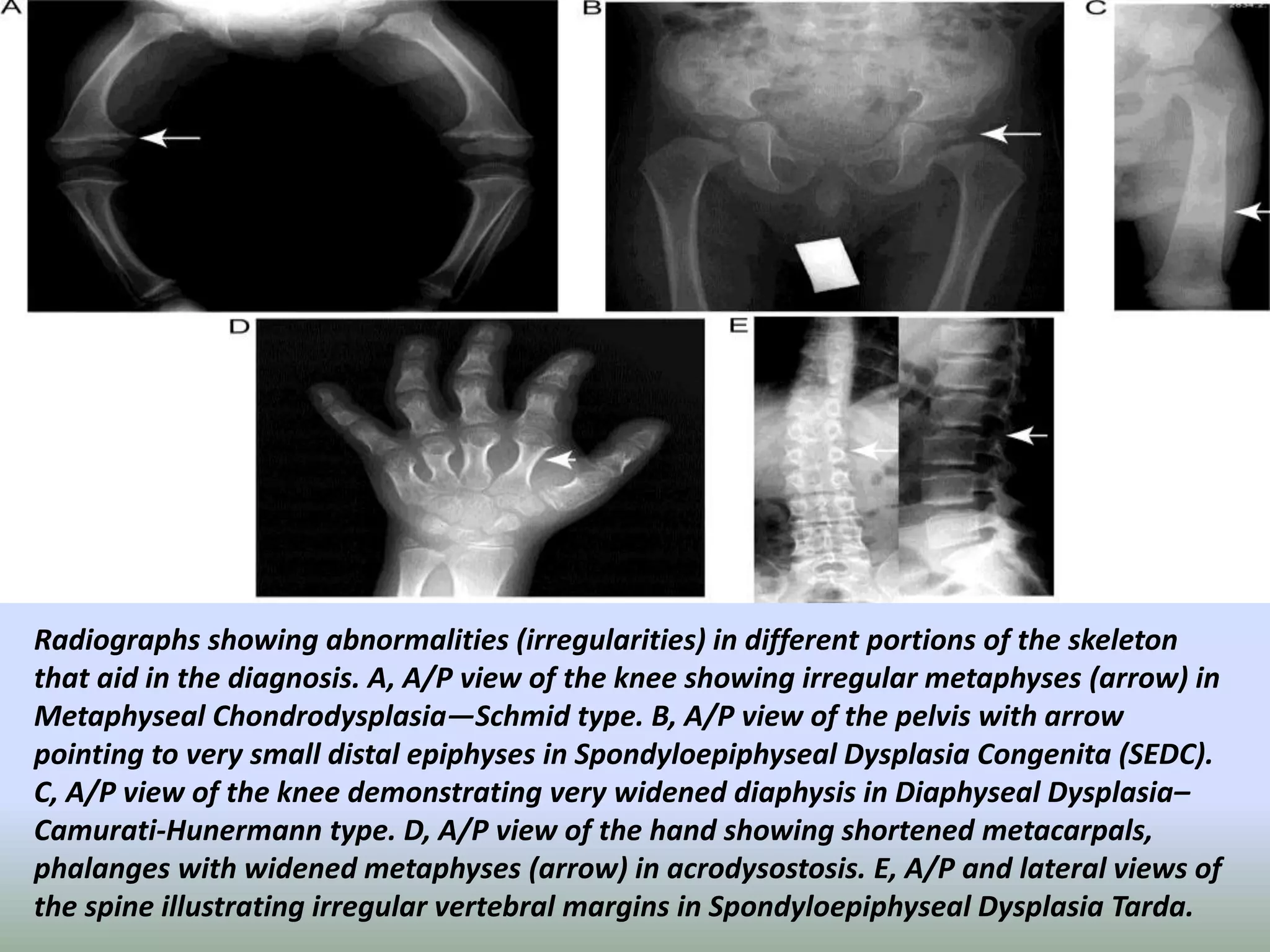 Radiographs showing abnormalities (irregularities) in different portions of the skeleton 
that aid in the diagnosis. A, A/P view of the knee showing irregular metaphyses (arrow) in 
Metaphyseal Chondrodysplasia—Schmid type. B, A/P view of the pelvis with arrow 
pointing to very small distal epiphyses in Spondyloepiphyseal Dysplasia Congenita (SEDC). 
C, A/P view of the knee demonstrating very widened diaphysis in Diaphyseal Dysplasia– 
Camurati-Hunermann type. D, A/P view of the hand showing shortened metacarpals, 
phalanges with widened metaphyses (arrow) in acrodysostosis. E, A/P and lateral views of 
the spine illustrating irregular vertebral margins in Spondyloepiphyseal Dysplasia Tarda. 
 