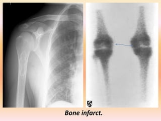 Intramedullary Bone Infarct Presentation1.pptx, lecture for md oral examination. | PPTX