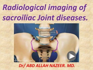 Radiological imaging of 
sacroiliac Joint diseases. 
Dr/ ABD ALLAH NAZEER. MD. 
 
