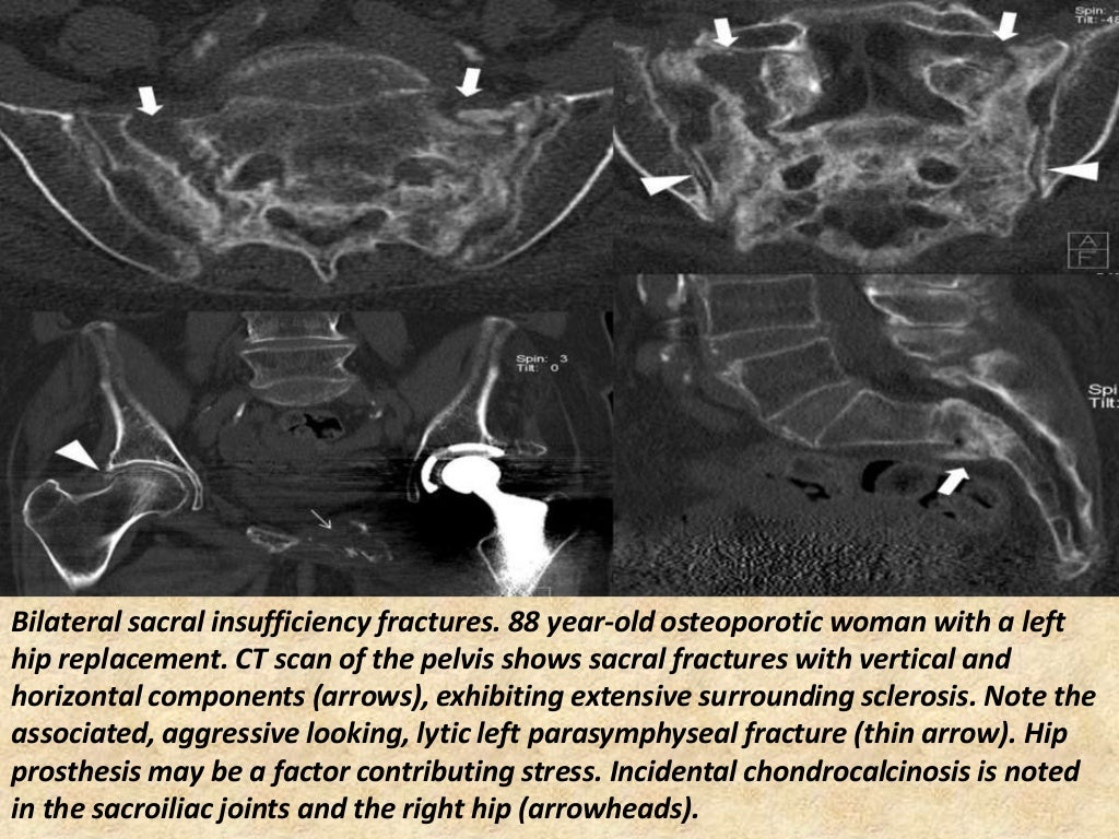Presentation1.pptx, radiological imaging of sacroiliac joint diseases.