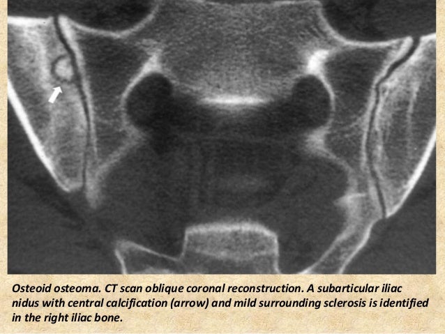 Presentation1.pptx, radiological imaging of sacroiliac joint diseases.