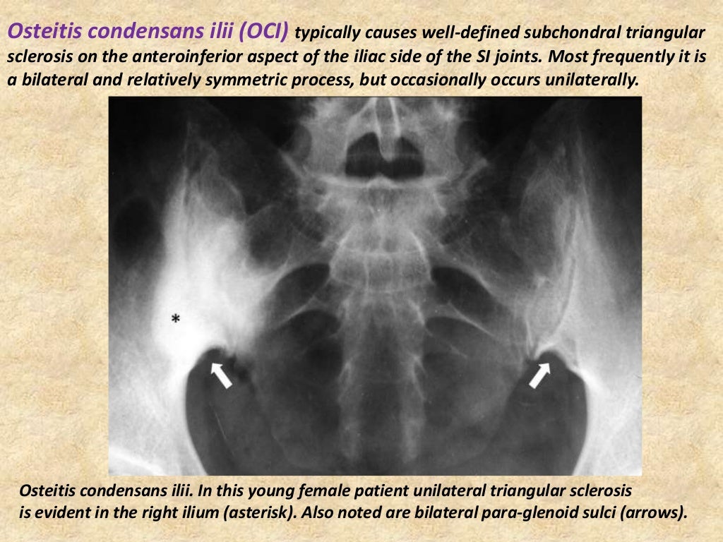 Presentation1.pptx, radiological imaging of sacroiliac joint diseases.