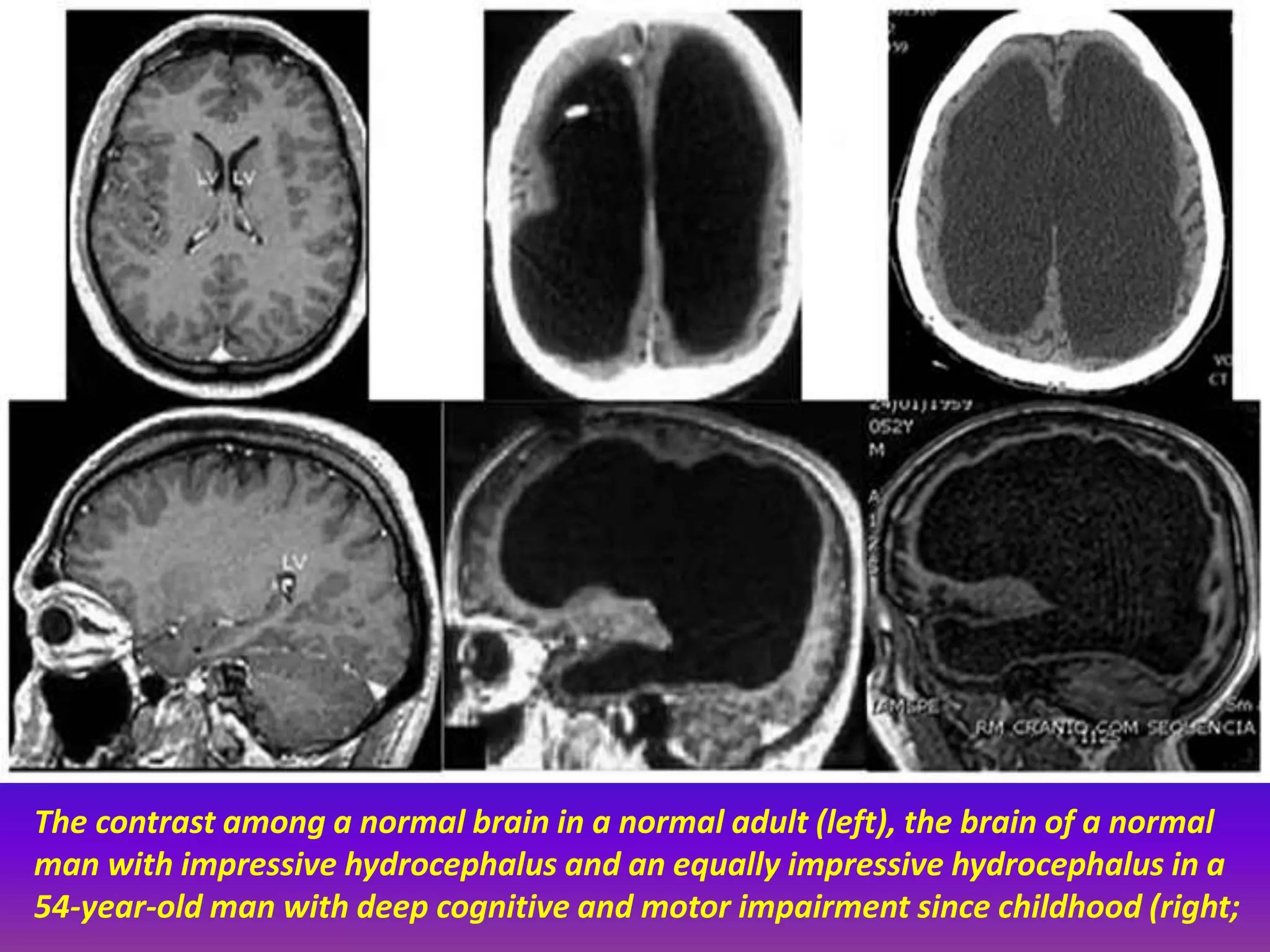 The contrast among a normal brain in a normal adult (left), the brain of a normal 
man with impressive hydrocephalus and an equally impressive hydrocephalus in a 
54-year-old man with deep cognitive and motor impairment since childhood (right; 
 