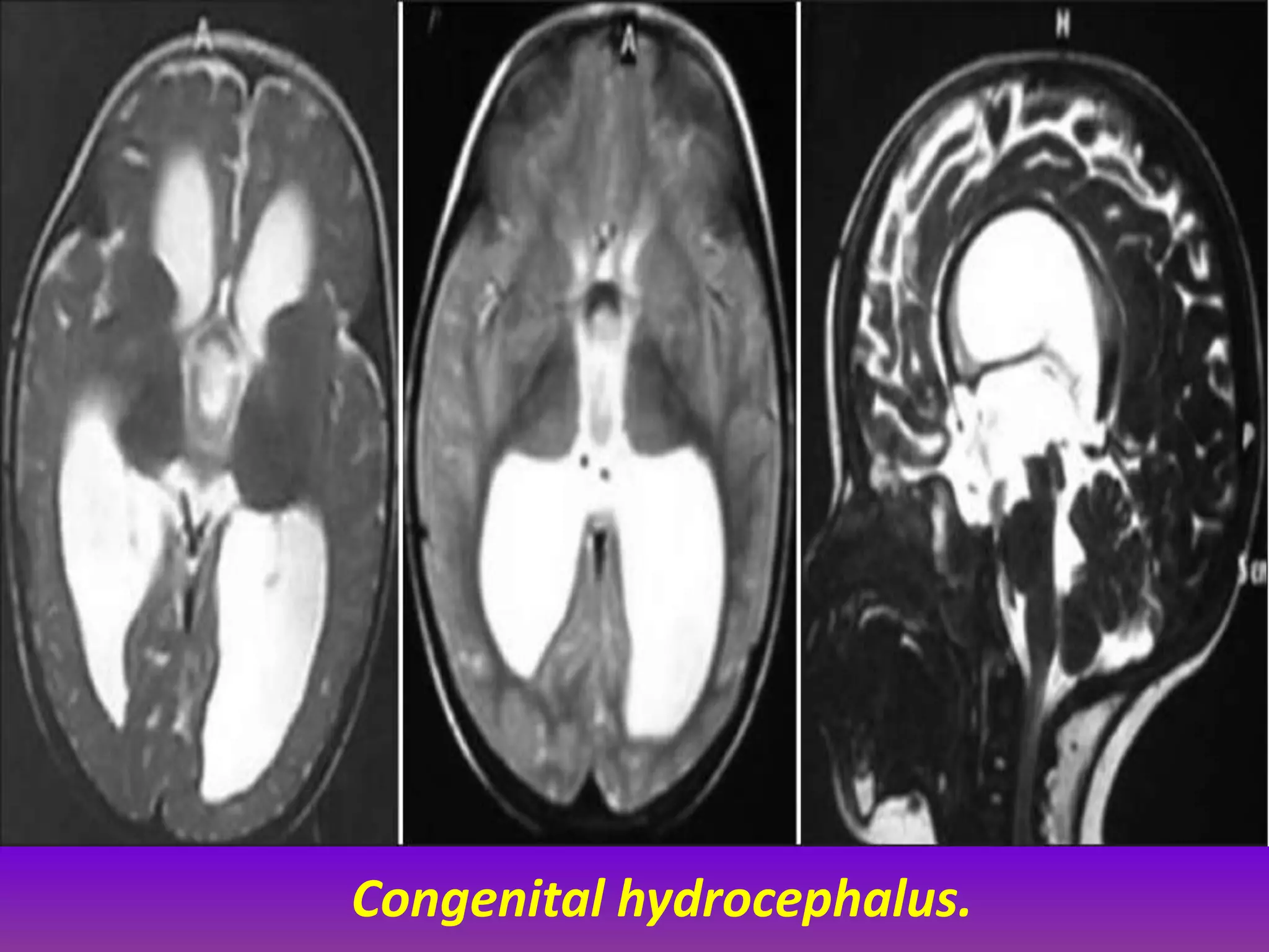 Congenital hydrocephalus. 
 