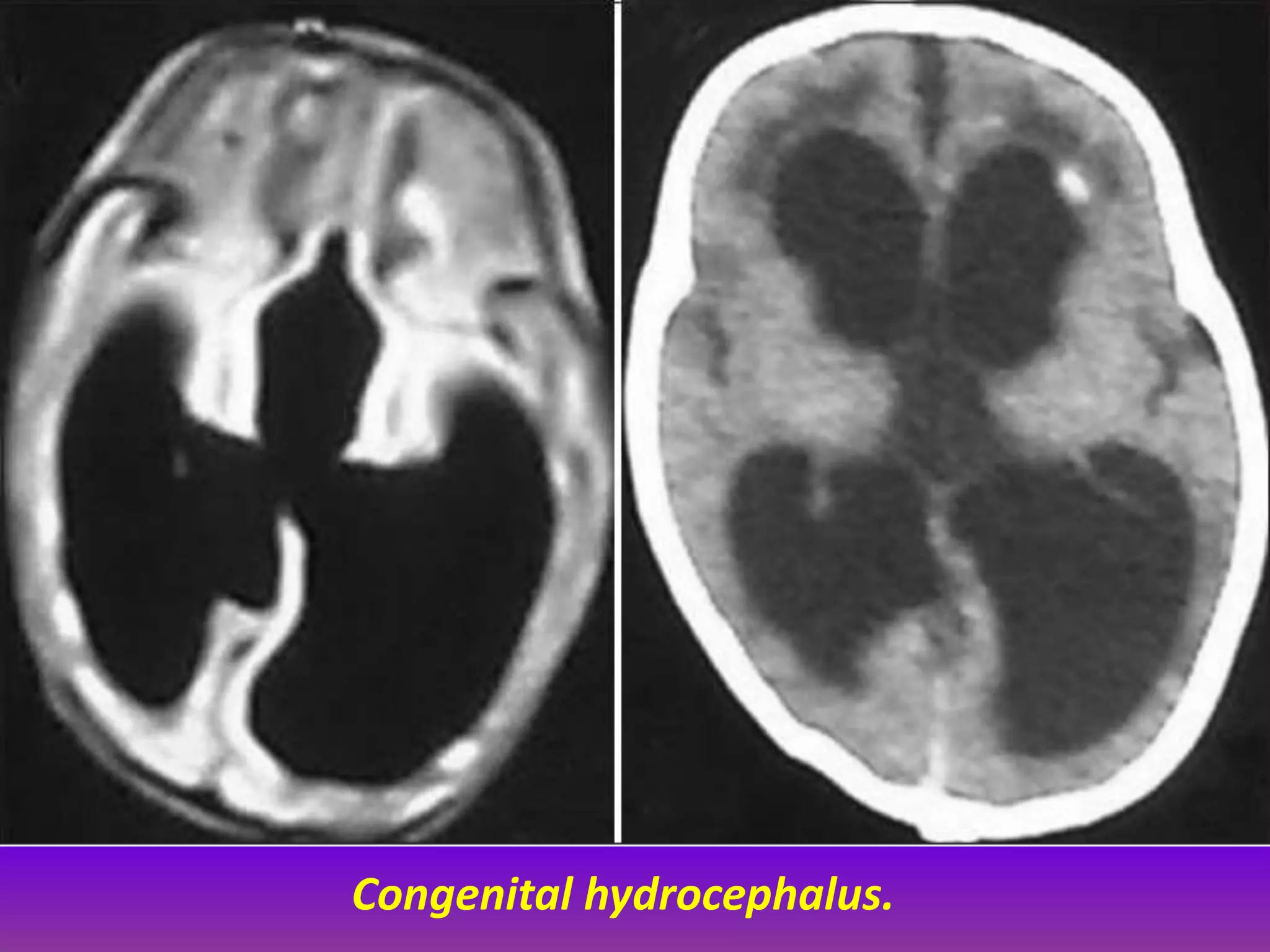 Congenital hydrocephalus. 
 