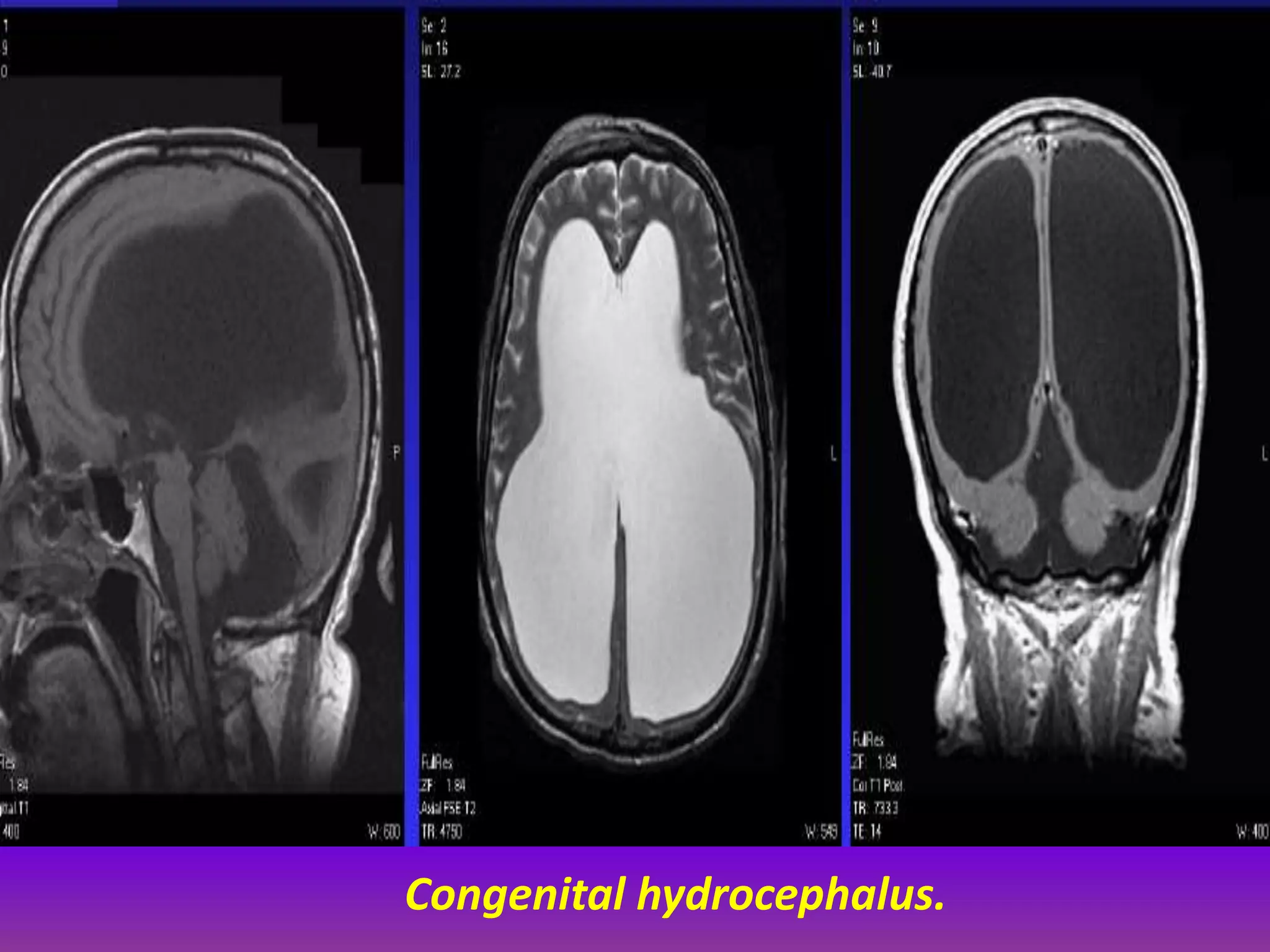 Congenital hydrocephalus. 
 